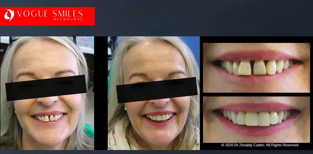 Before and After Smile Makeovers Melbourne - Australia's Top Cosmetic Dentist - VOGUE SMILES MELBOURNE