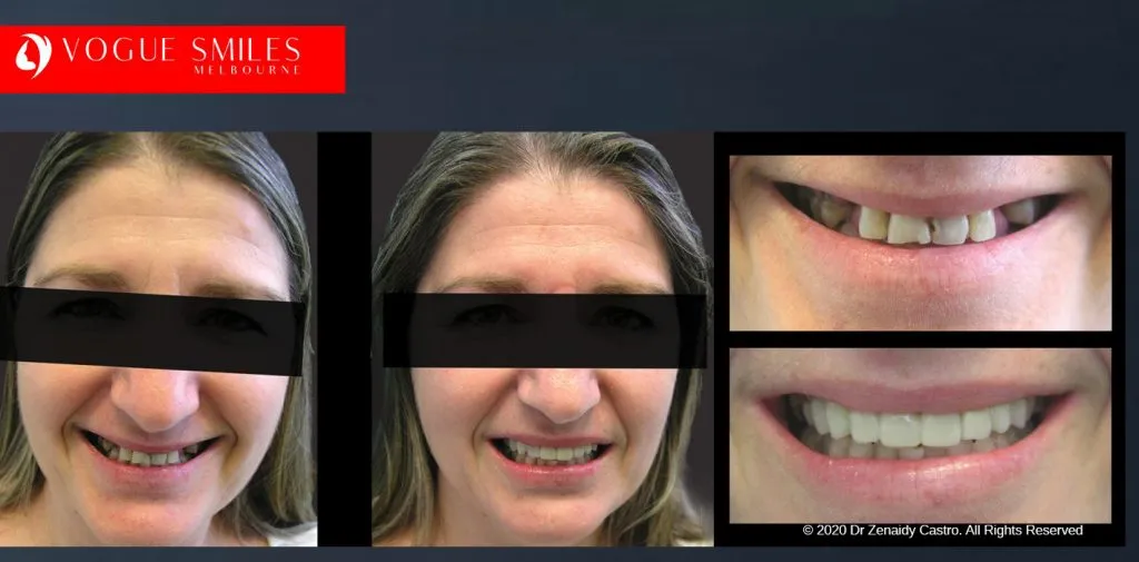 Before and After Smile Makeovers Melbourne - Australia's Top Cosmetic Dentist - VOGUE SMILES MELBOURNE