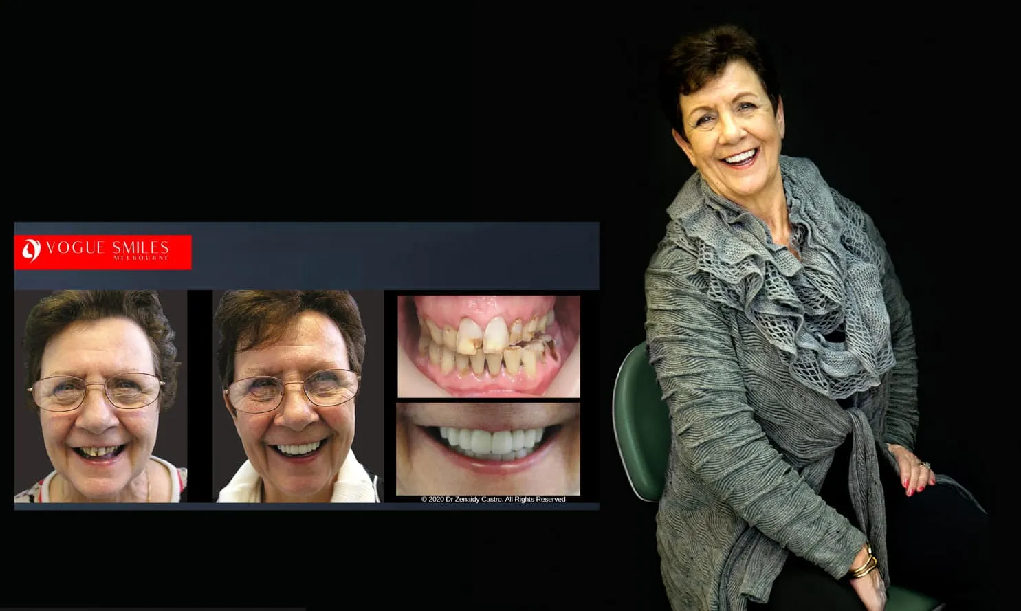 Beautiful Smiles with Lumineers Veneers Melbourne CBD | Dental Veneers Melbourne