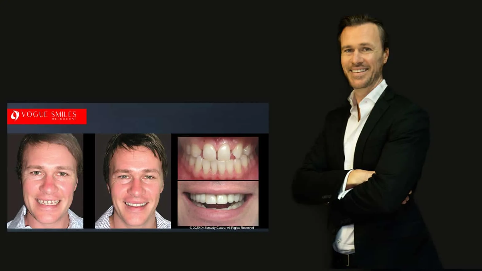 Beautiful Smiles with Lumineers Veneers Melbourne CBD | Dental Veneers Melbourne