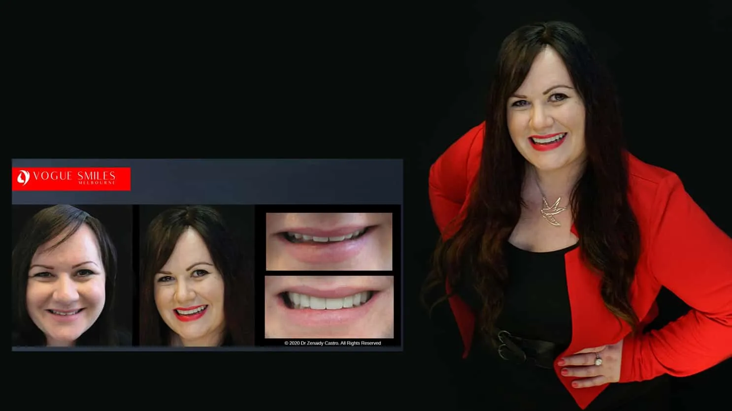 Beautiful Smiles with Lumineers Veneers Melbourne CBD | Dental Veneers Melbourne