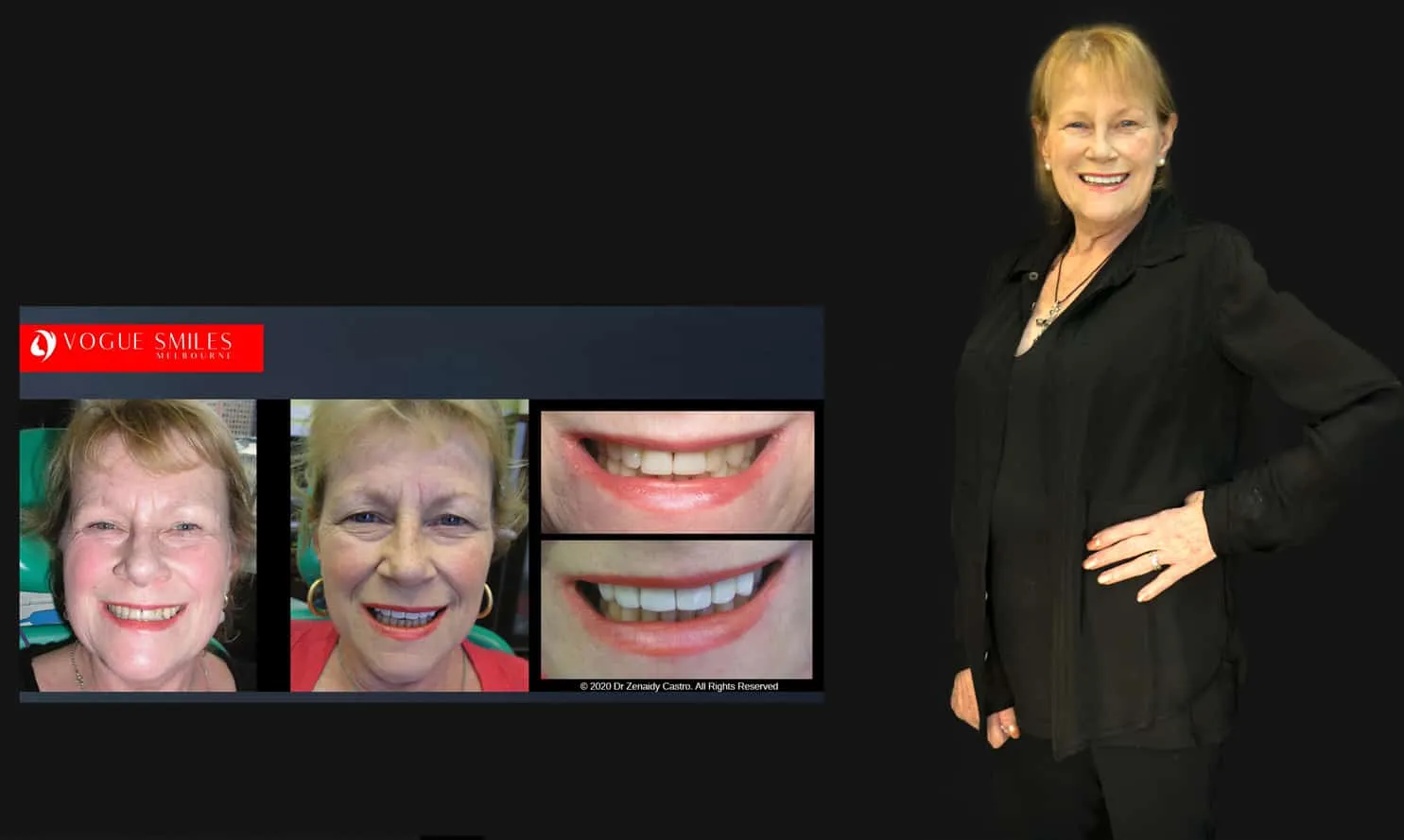 Beautiful Smiles with Lumineers Veneers Melbourne CBD | Dental Veneers Melbourne