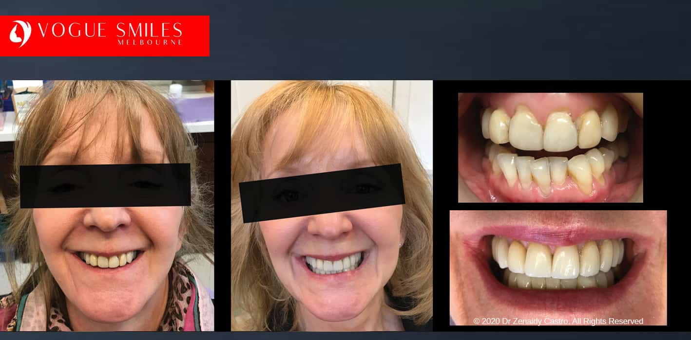 Before and After | Dental Crowns and Bridges | Vogue Smiles