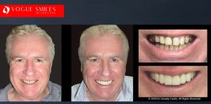 Affordable Dental Crowns and Dental Bridges Melbourne BEFORE & AFTER - Tooth Capping Melbourne - Implant replacement with Bridgework