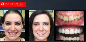 Porcelain Veneers Before and After Melbourne - Veneer Cost Melbourne From $700 per tooth *- Dental Veneers Smile Gallery - VOGUE SMILES COSMETIC DENTAL