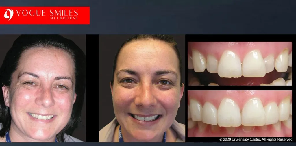 Porcelain Veneers Before and After Melbourne - Veneer Cost Melbourne From $700 per tooth *- Dental Veneers Smile Gallery - VOGUE SMILES COSMETIC DENTAL