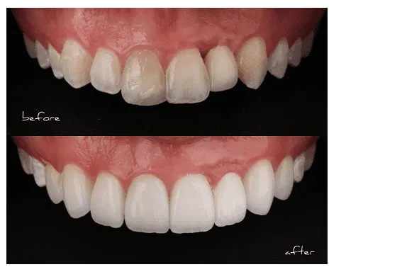 Porcelain Veneer Specials & Packages Melbourne CBD – Most Affordable Smile Makeover