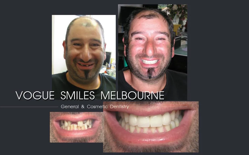 Dentist Melbourne - Melbourne CBD Dental Clinic - DENTIST NEAR ME | VOGUE SMILES MELBOURNE-BEST DENTIST IN MELBOURNE REVIEWS