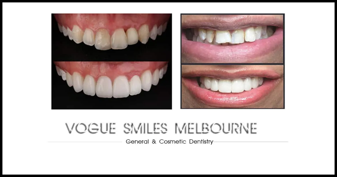 Cheapest Porcelain Veneers Cost in Melbourne and Noble Park North with our Specials & Packages