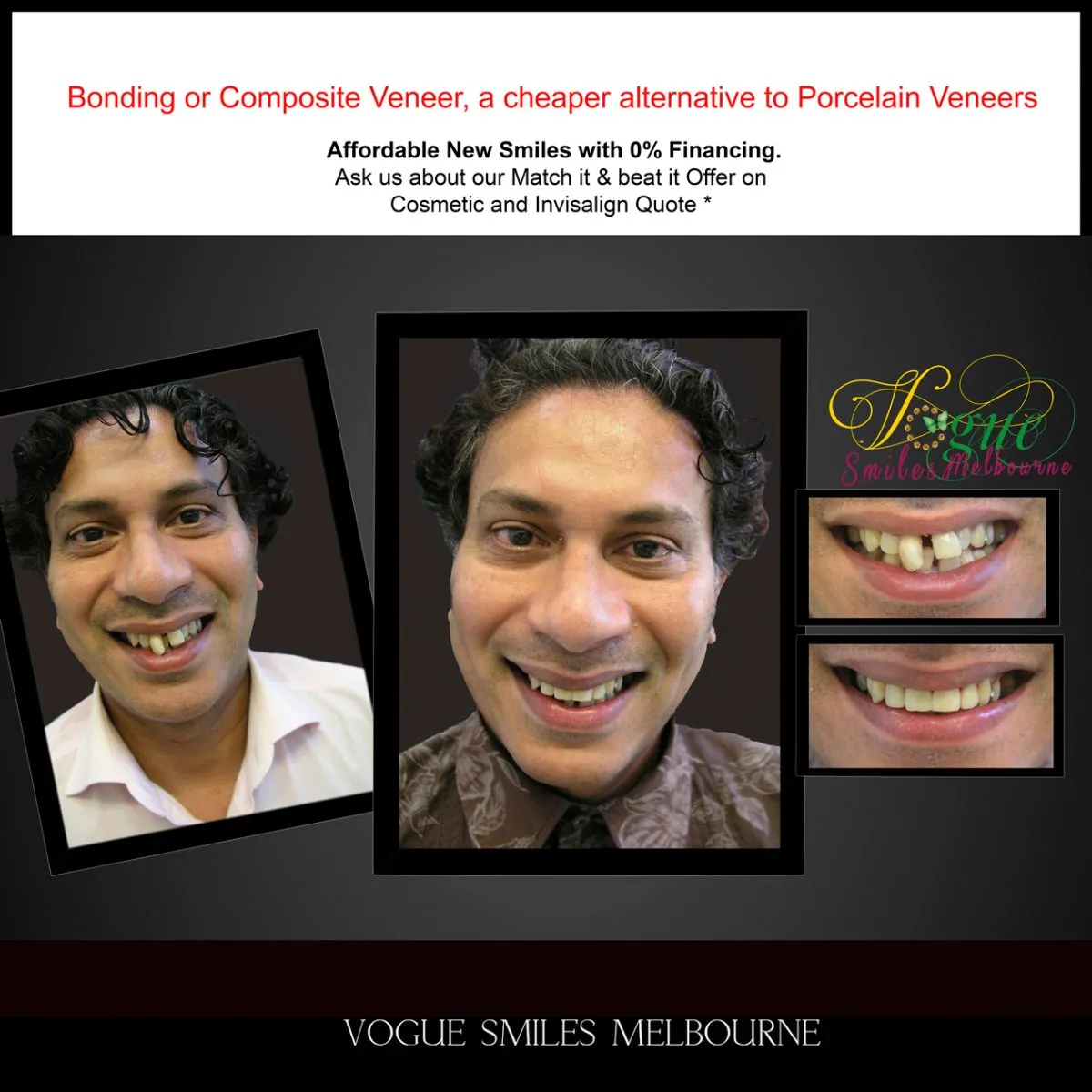 DENTAL BONDING IN MELBOURNE -COMPOSITE RESIN VENEERS -TOP COSMETIC DENTIST MELBOURNE