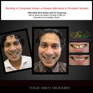 DENTAL BONDING IN MELBOURNE -COMPOSITE RESIN VENEERS -TOP COSMETIC DENTIST MELBOURNE