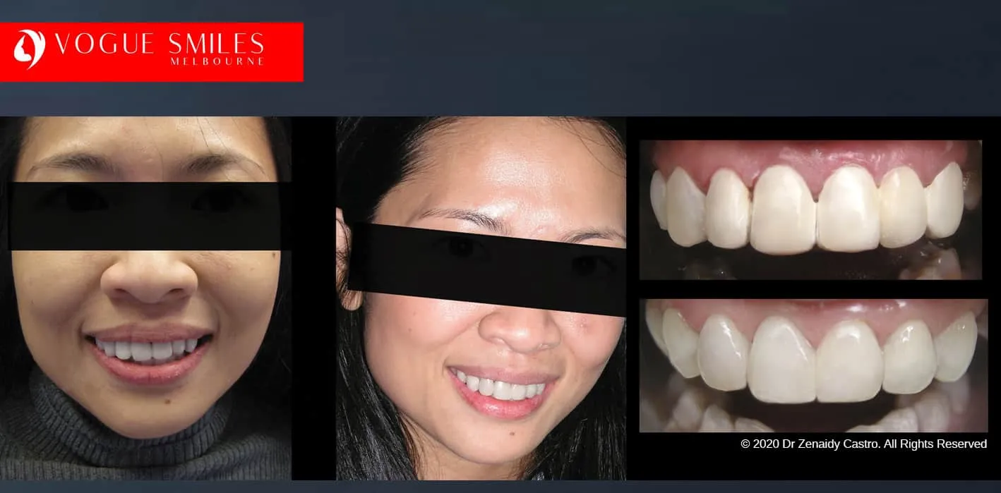 Is there a cheaper option than veneers?- Composite Veneers, Dental Bonding Melbourne CBD and Noble Park North