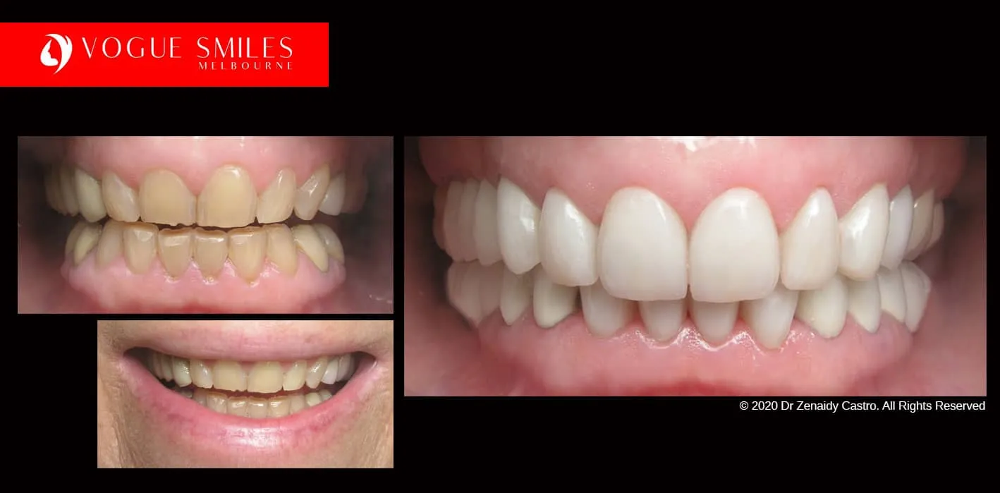 Porcelain Dental Crowns Melbourne City 3000 Victoria Australia