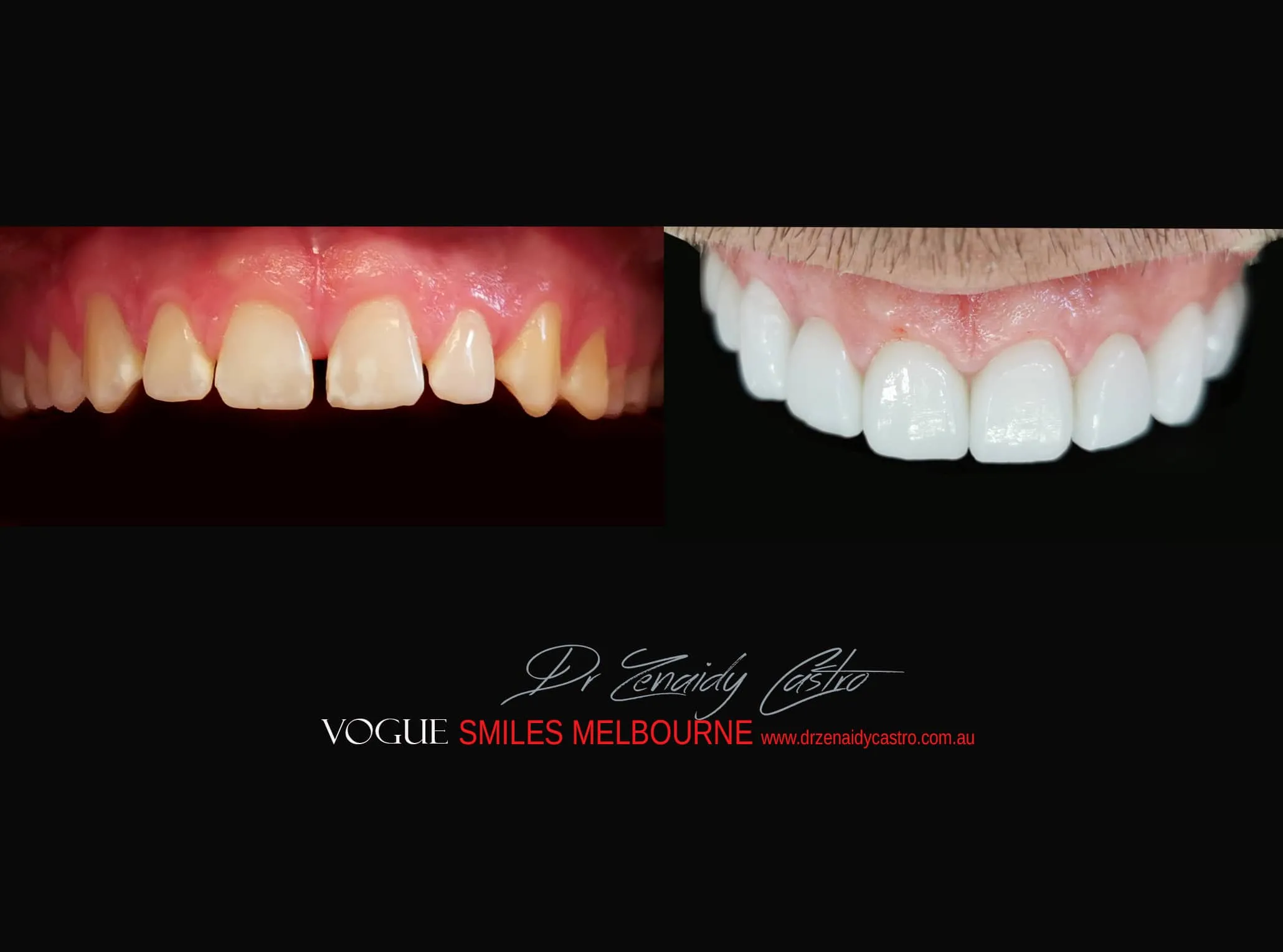 Tooth Bonding for gaps between teeth Melbourne CBD, composite bonding gap front teeth, Cosmetic Bonding, bonding gaps in teeth cost, gaps in front teeth