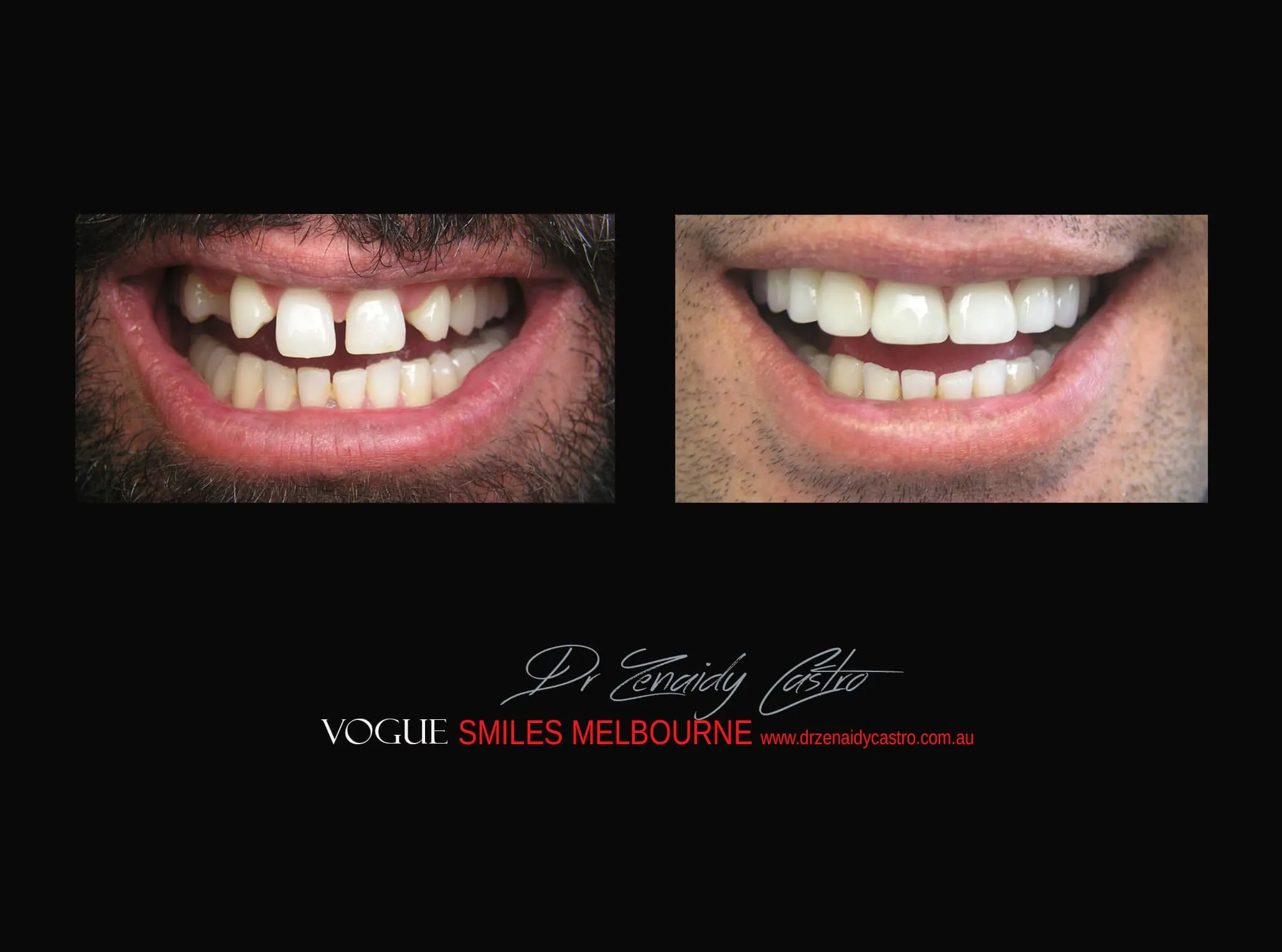 Gappy Teeth Treatment Melbourne with Porcelain Veneers | Veneers for Gappy Smile treatment Cosmetic Dentist Melbourne CBD