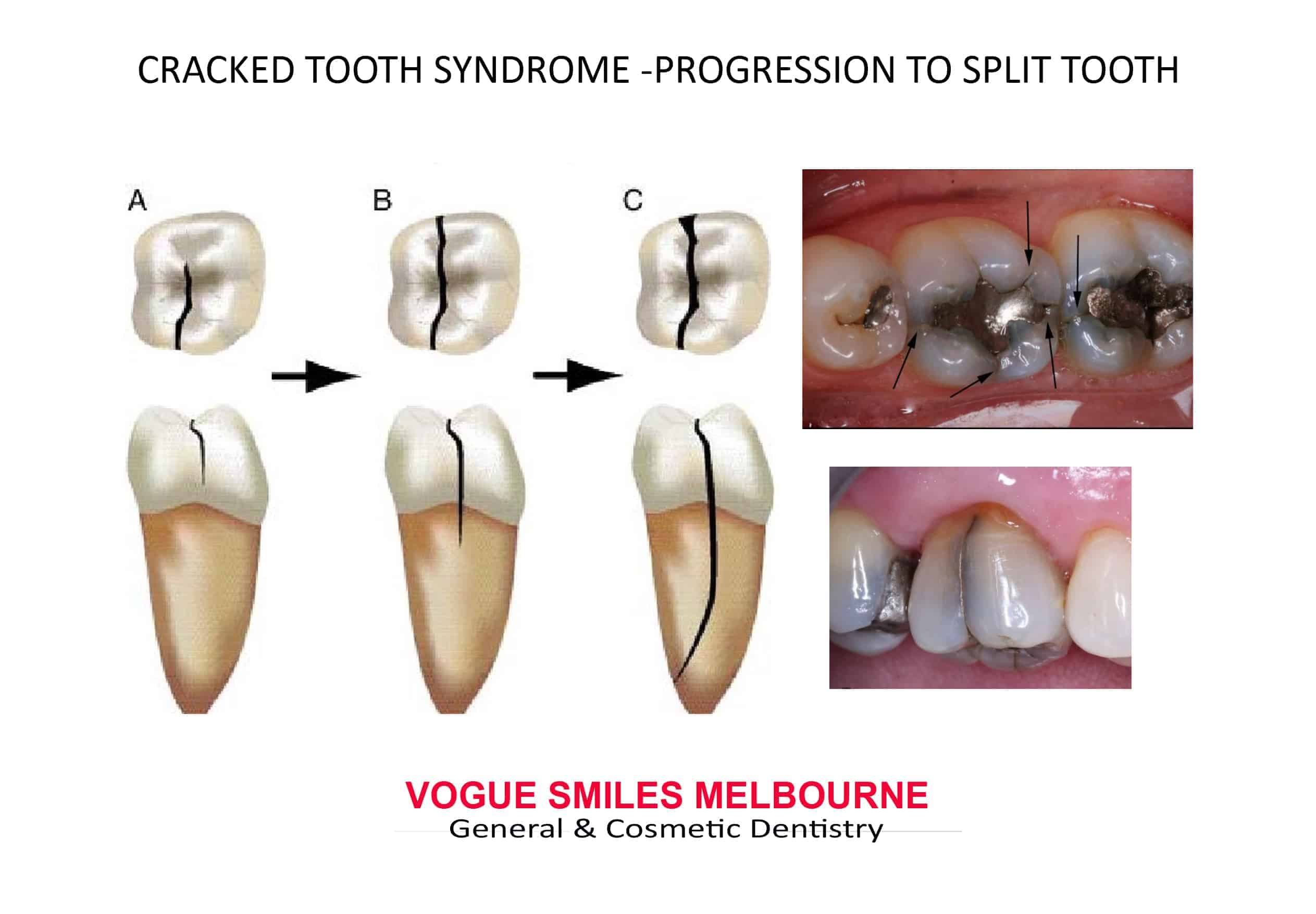 Cracked Tooth Cracked Tooth Syndrome