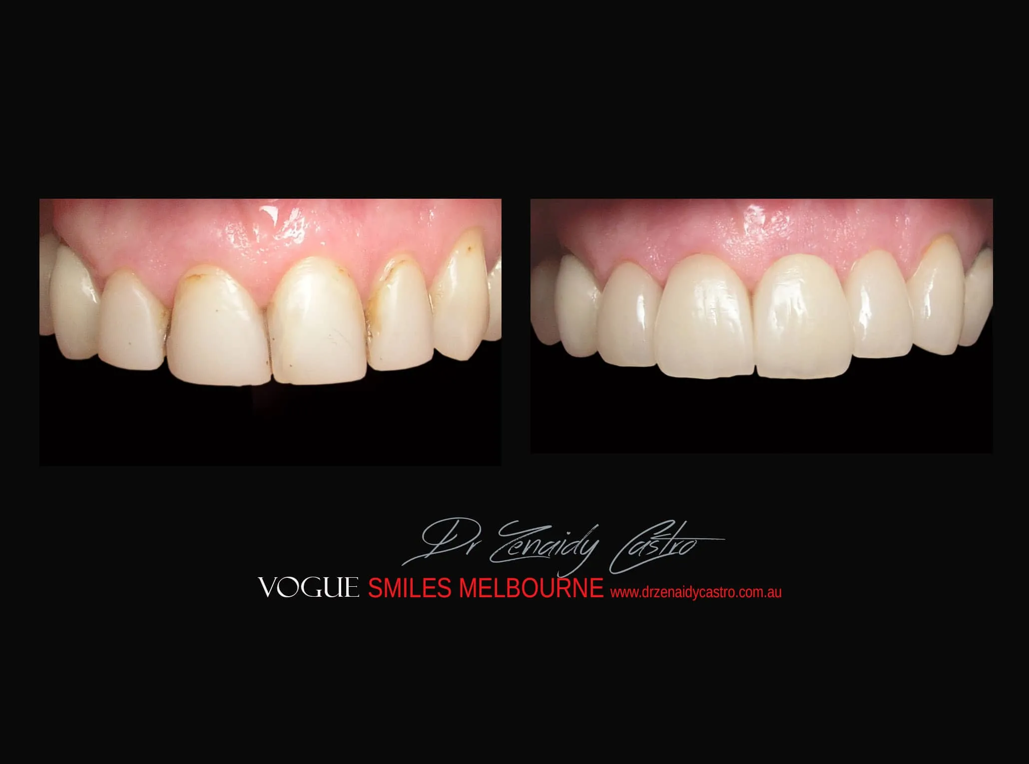 Dental Bonding. Cosmetic Dental Bonding, Composite Veneers versus PORCELAIN VENEERS Melbourne - Best Cosmetic Dentist 