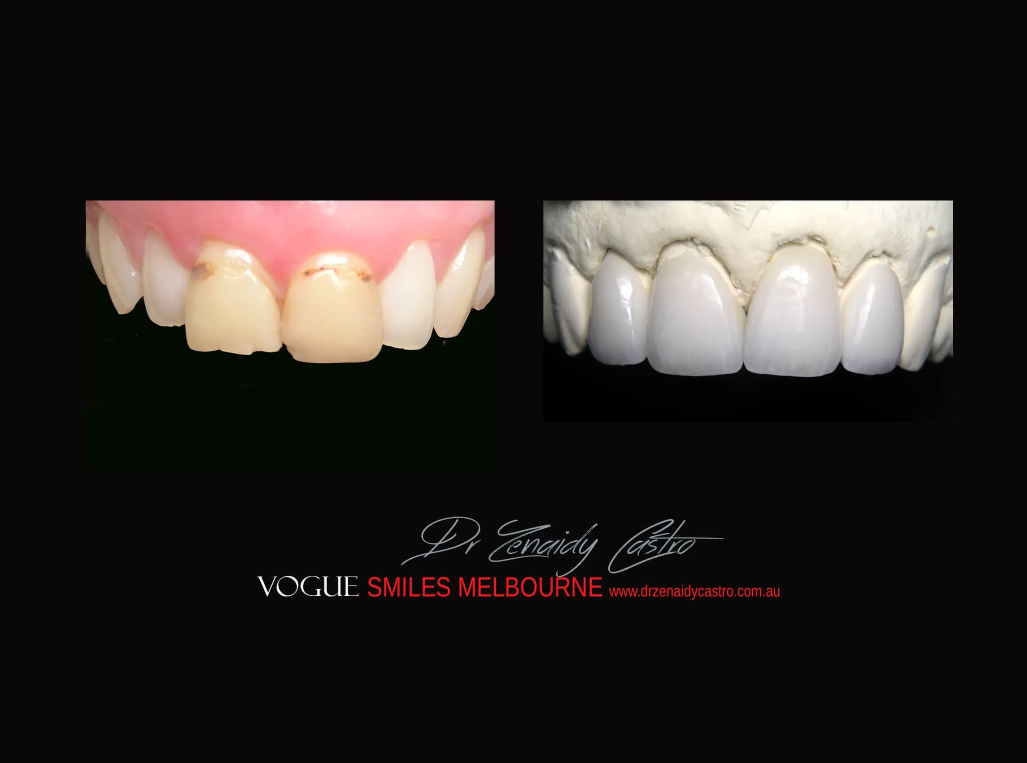 Dental Bonding. Cosmetic Dental Bonding, Composite Veneers versus PORCELAIN VENEERS Melbourne - Best Cosmetic Dentist 