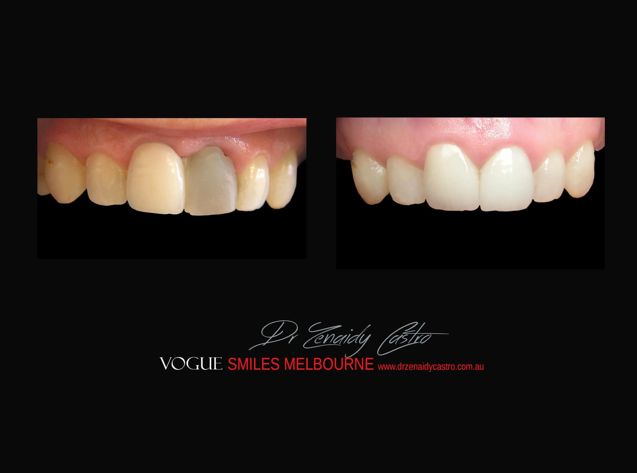 Dental Bonding. Cosmetic Dental Bonding, Composite Veneers versus PORCELAIN VENEERS Melbourne - Best Cosmetic Dentist 