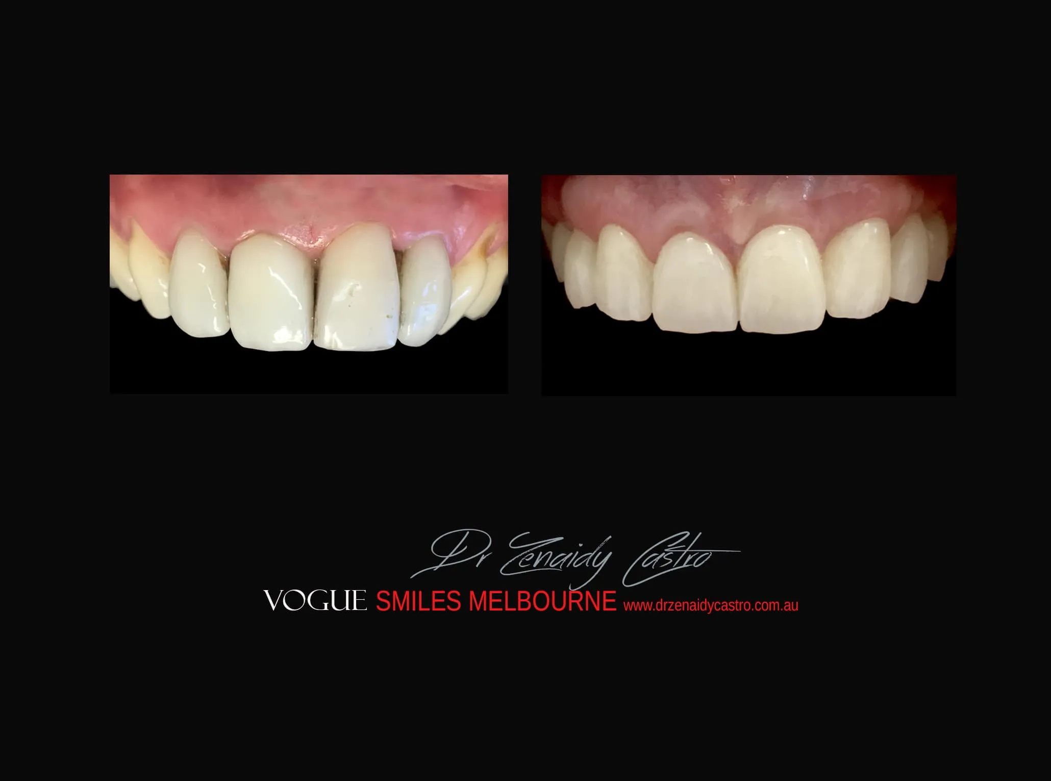 Dental Bonding. Cosmetic Dental Bonding, Composite Veneers versus PORCELAIN VENEERS Melbourne - Best Cosmetic Dentist 