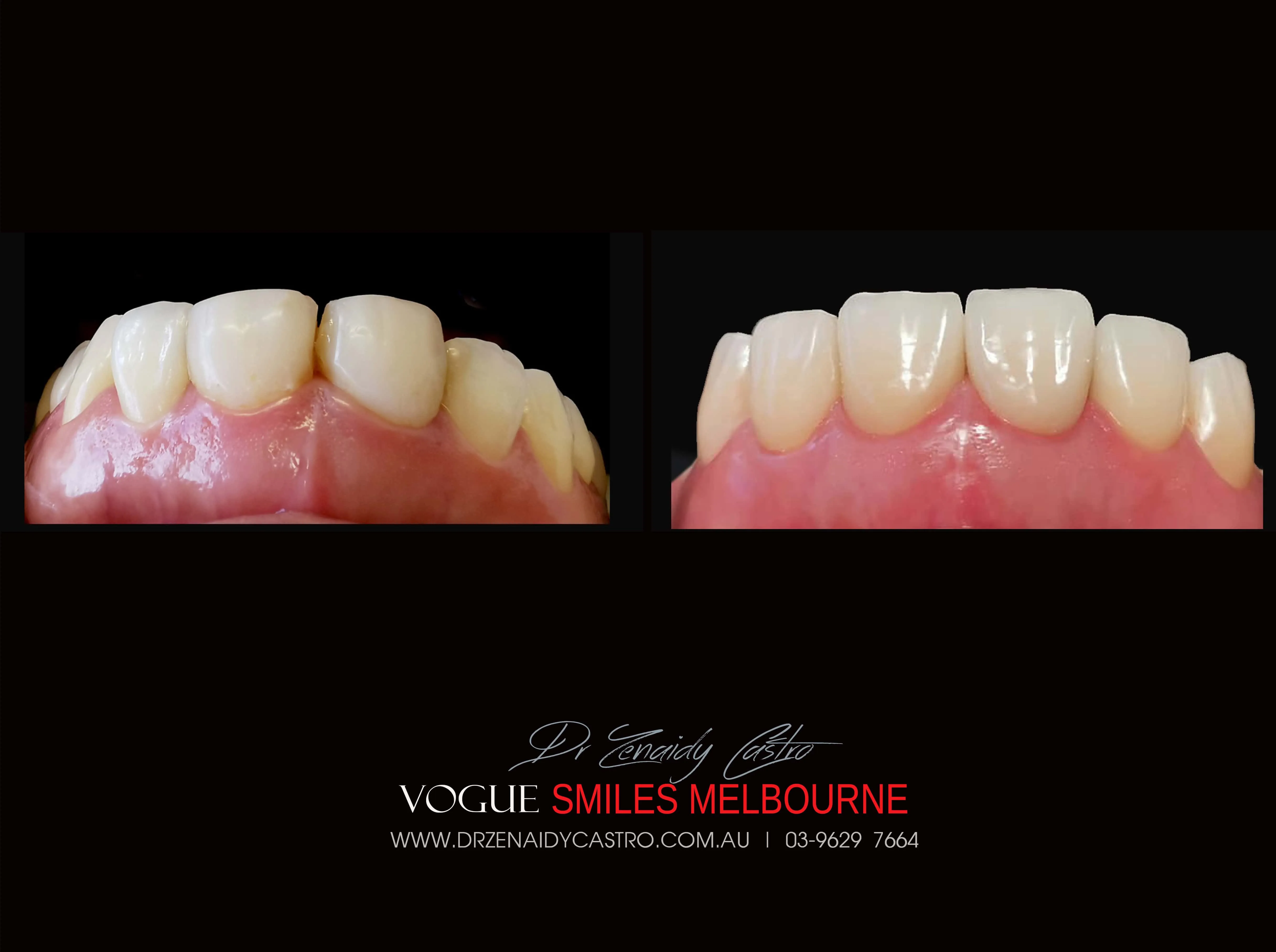 Fixing Short, Worn Down, Grinded down Teeth | Worn Teeth Treatment with Dental Veneers Melbourne CBD Cosmetic Dentistry