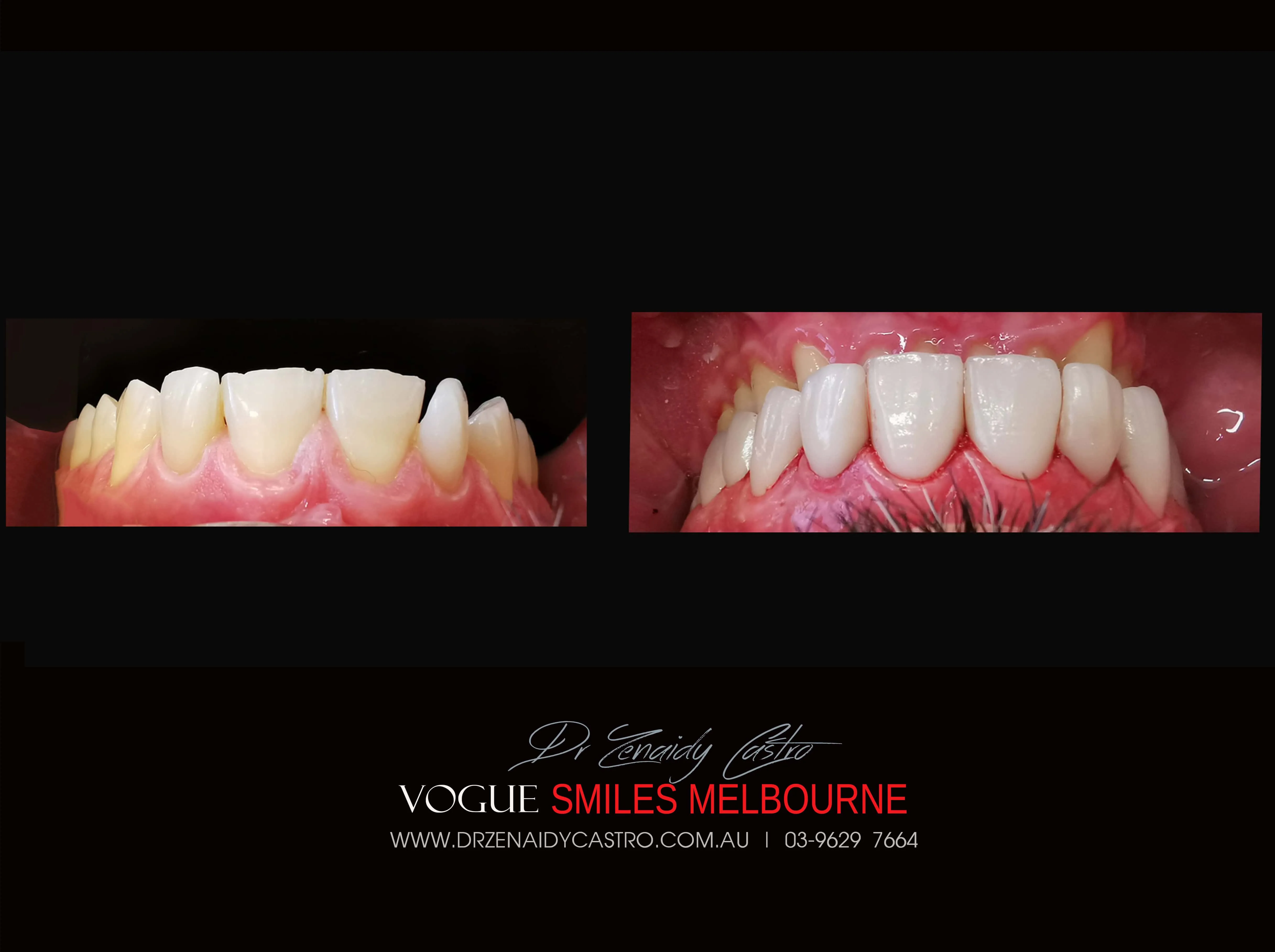 Short teeth, Worn-down, Grinded down teeth Treatment Melbourne CBD Cosmetic Dentist -Porcelain Veneer for worn down teeth