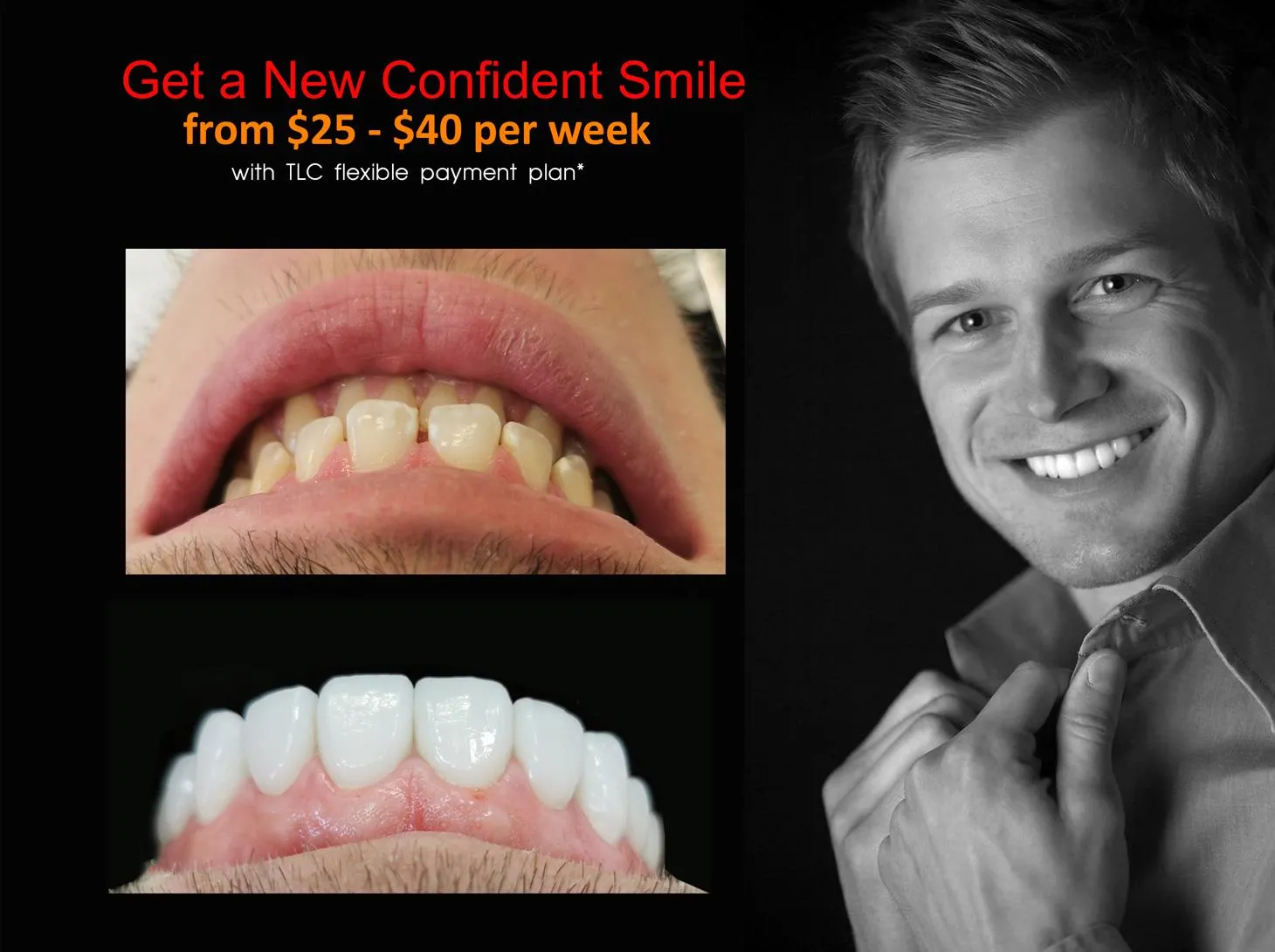 Veneers and Smile Makeovers in Melbourne CBD and Noble Park north | Lowest, CHEAPEST Price in Melbourne