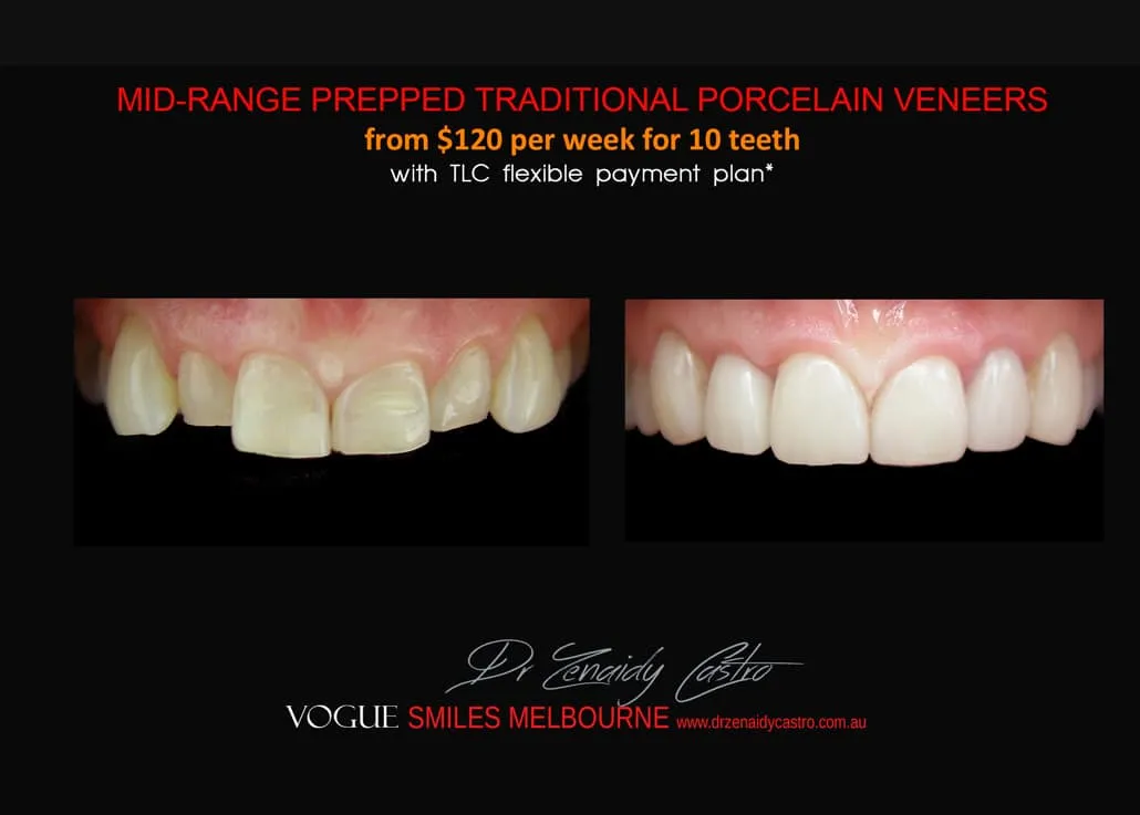 Composite Veneers Vs. Porcelain Veneers Melbourne CBD - Cosmetic Bonding versus Ceramic dental Veneers Melbourne