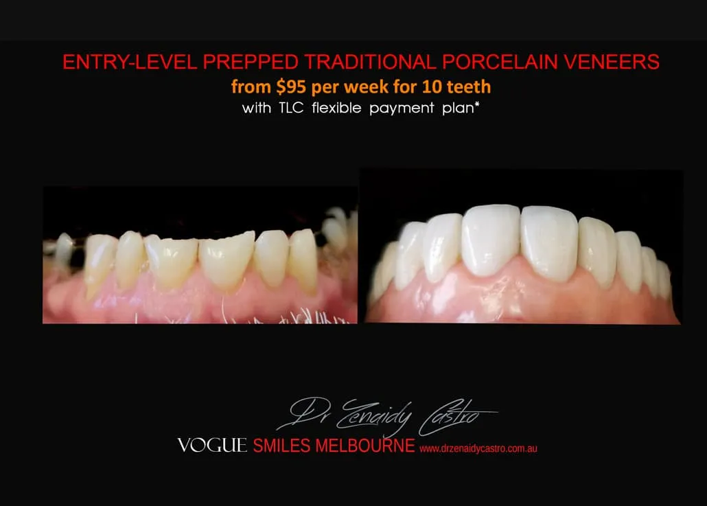 Composite Veneers Vs. Porcelain Veneers Melbourne CBD - Cosmetic Bonding versus Ceramic dental Veneers Melbourne