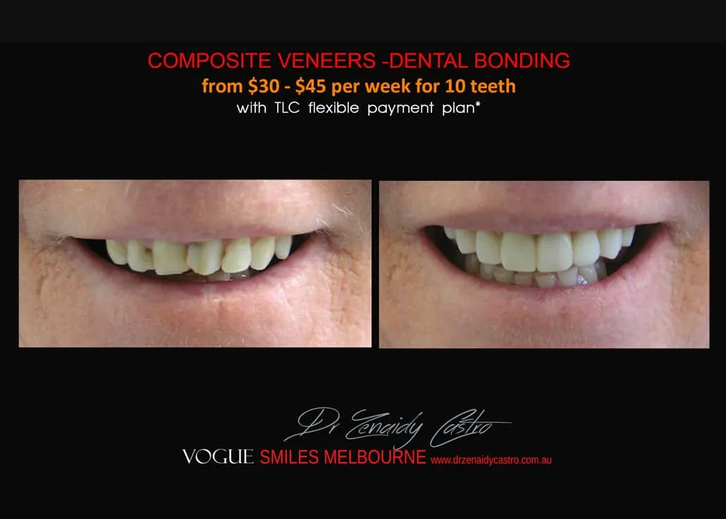 HOW MUCH DOES THE Cosmetic Dental Bonding or Composite Veneers COST IN MELBOURNE, Cost of Cosmetic Dental Bonding or Composite Veneers in Melbourne CBD?