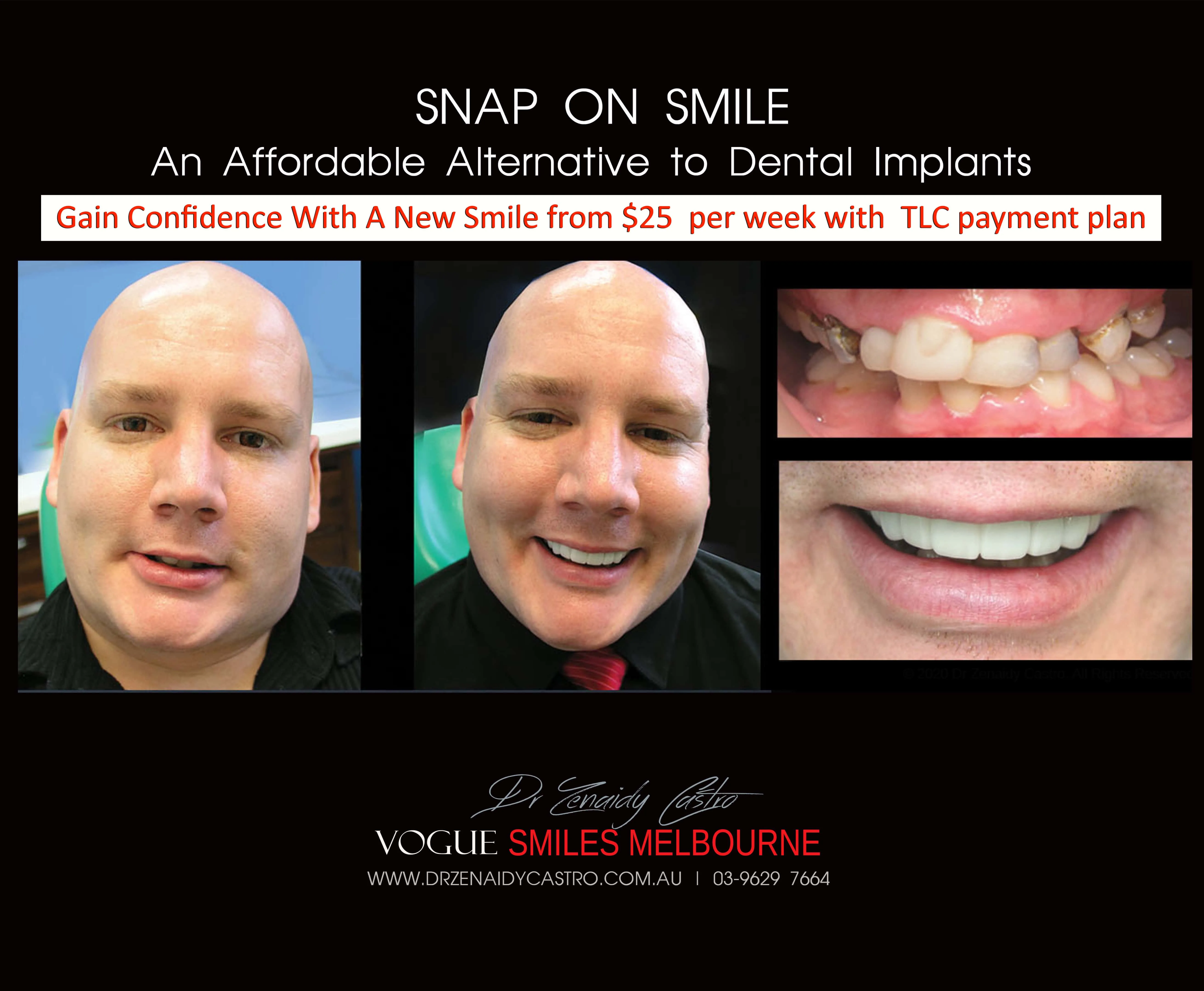 Cheaper alternative to Dental Implants, All-on 4 implants & Bridges in replacing missing teeth with Snap-on Smile Melbourne CBD- Cheap affordable Cosmetic Dentistry in Melbourne Victoria Australia