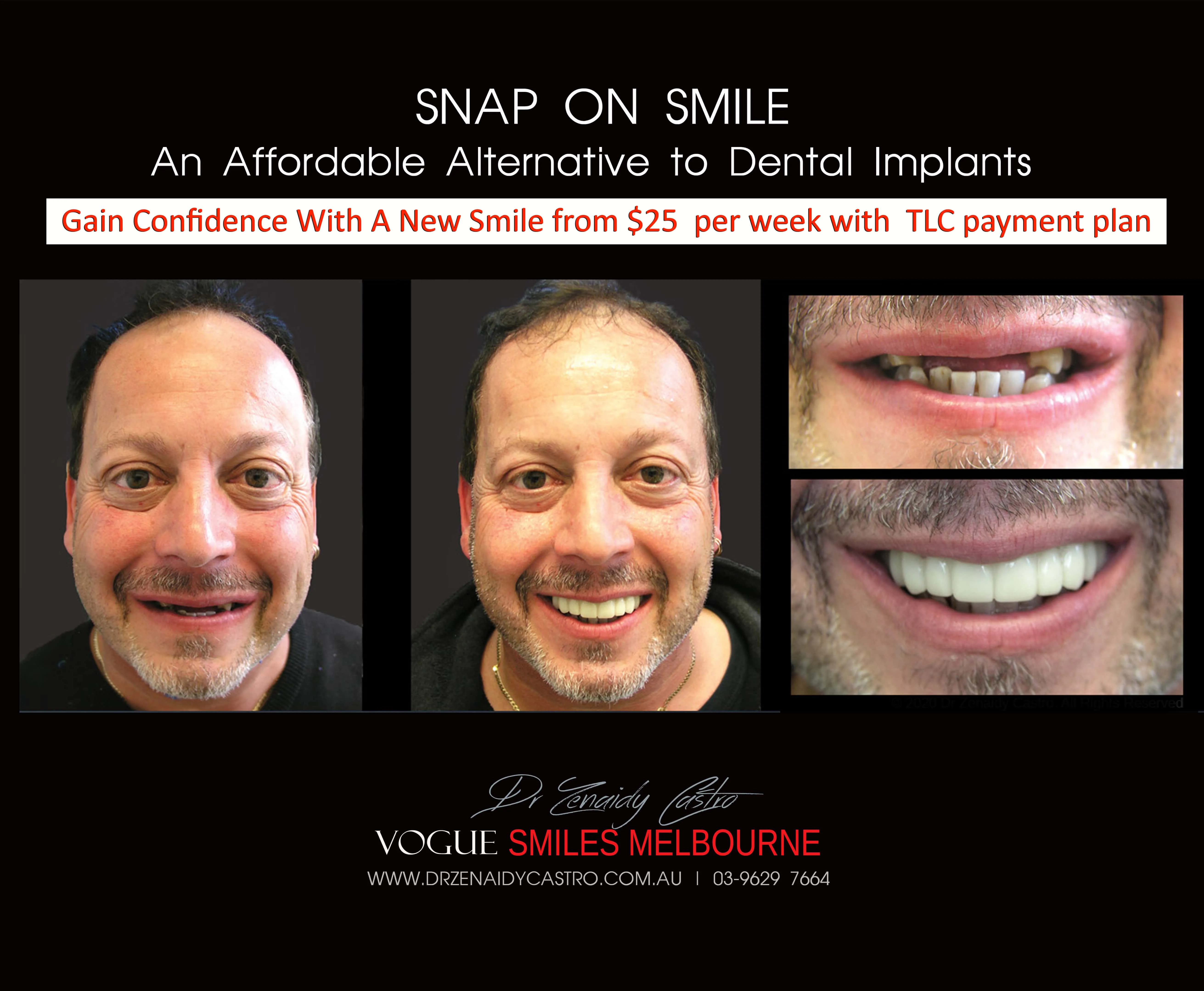 Cheaper alternative to Dental Implants, All-on 4 implants & Bridges in replacing missing teeth with Snap-on Smile Melbourne CBD- Cheap affordable Cosmetic Dentistry in Melbourne Victoria Australia