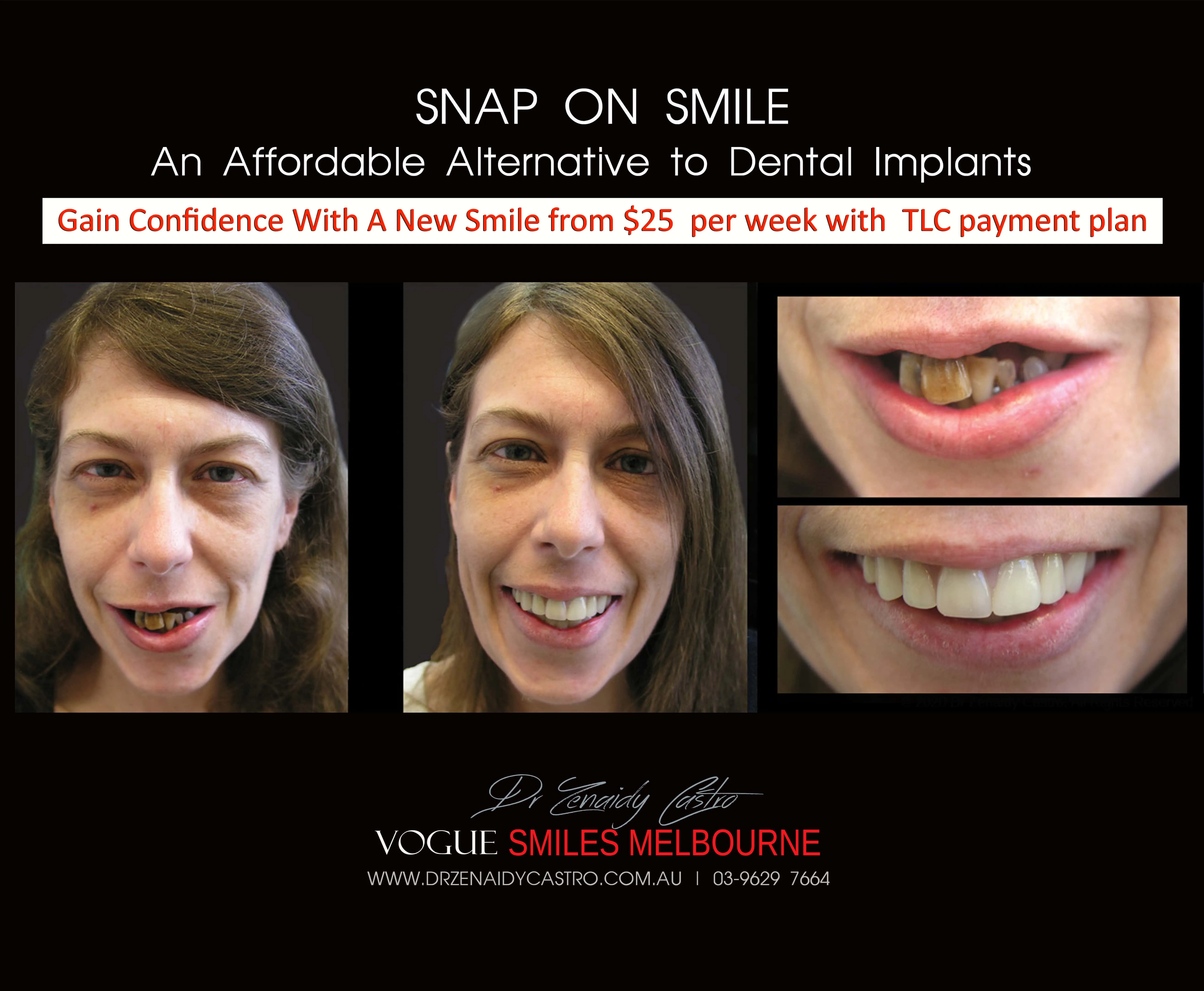 Cheaper alternative to Dental Implants, All-on 4 implants & Bridges in replacing missing teeth with Snap-on Smile Melbourne CBD- Cheap affordable Cosmetic Dentistry in Melbourne Victoria Australia