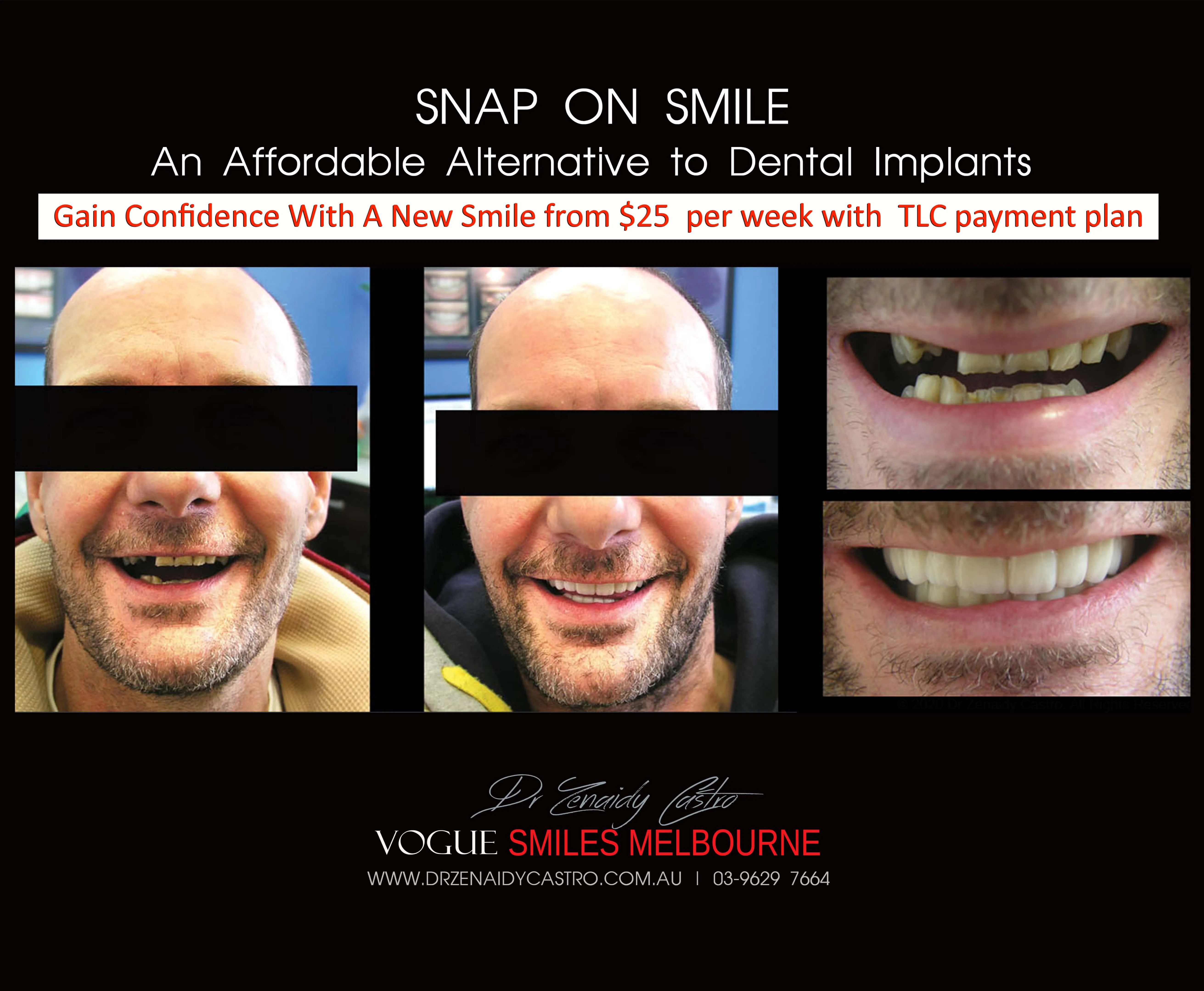 Cheaper alternative to Dental Implants, All-on 4 implants & Bridges in replacing missing teeth with Snap-on Smile Melbourne CBD- Cheap affordable Cosmetic Dentistry in Melbourne Victoria Australia