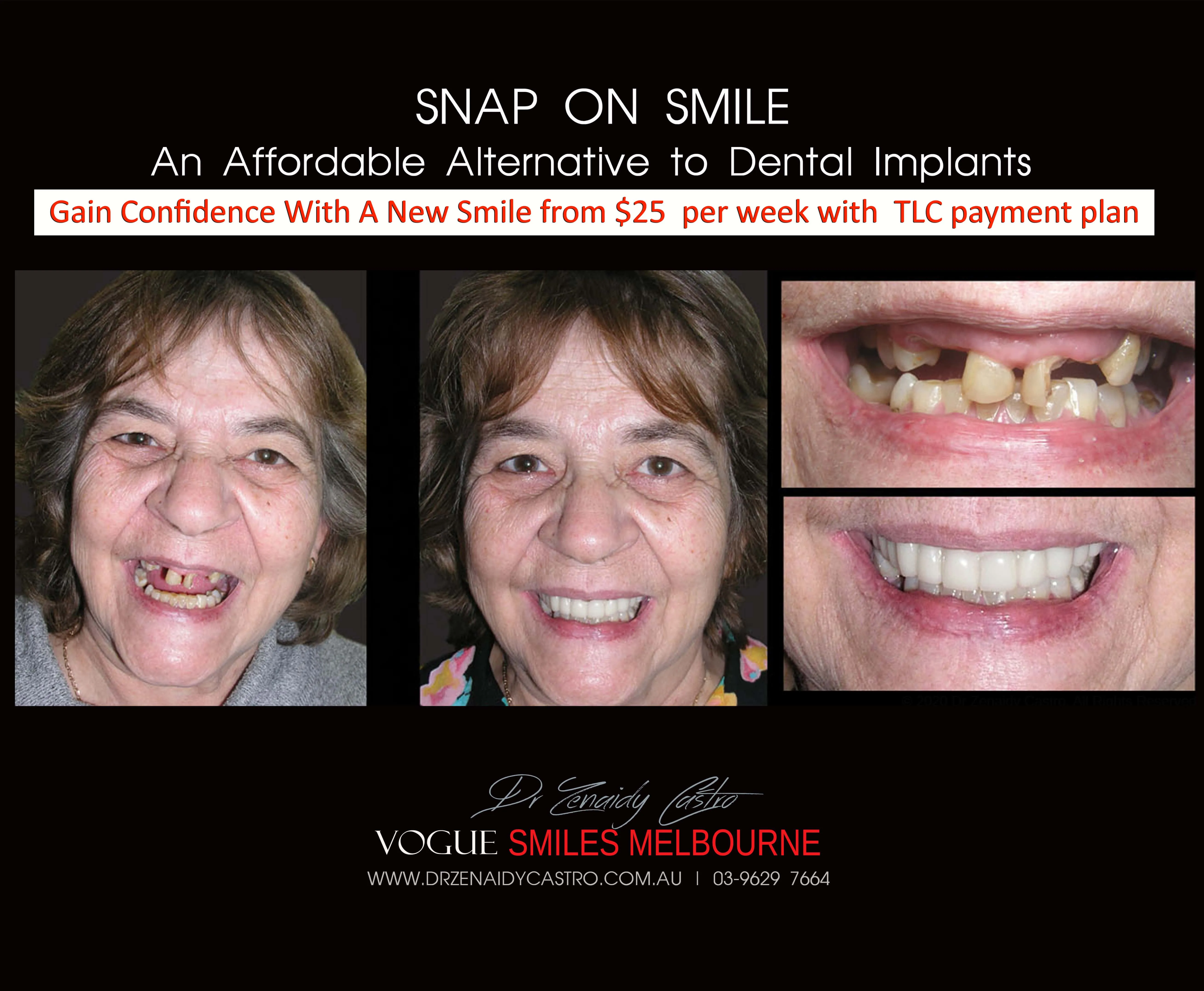 Cheaper alternative to Dental Implants, All-on 4 implants & Bridges in replacing missing teeth with Snap-on Smile Melbourne CBD- Cheap affordable Cosmetic Dentistry in Melbourne Victoria Australia