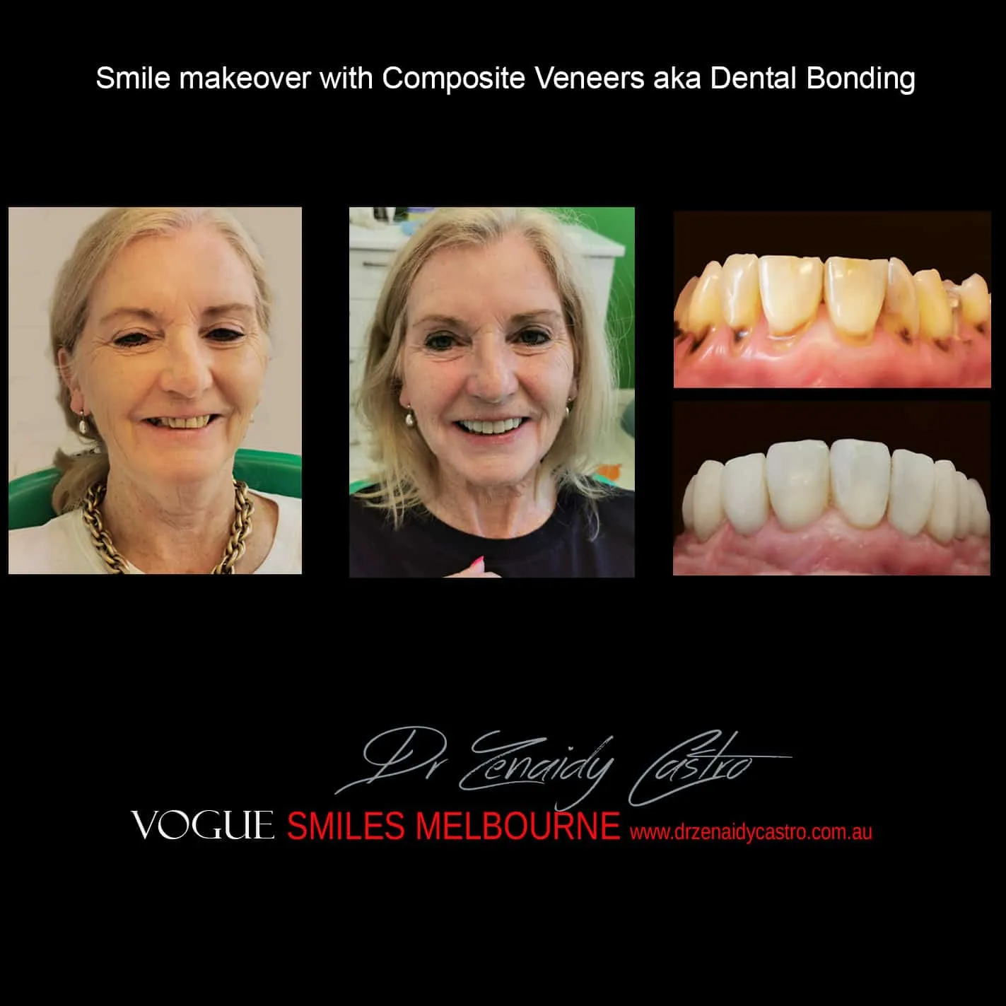 How to look younger Smile Makeover Melbourne CBD | Smile Rejuvenation with Smile Makeover Melbourne