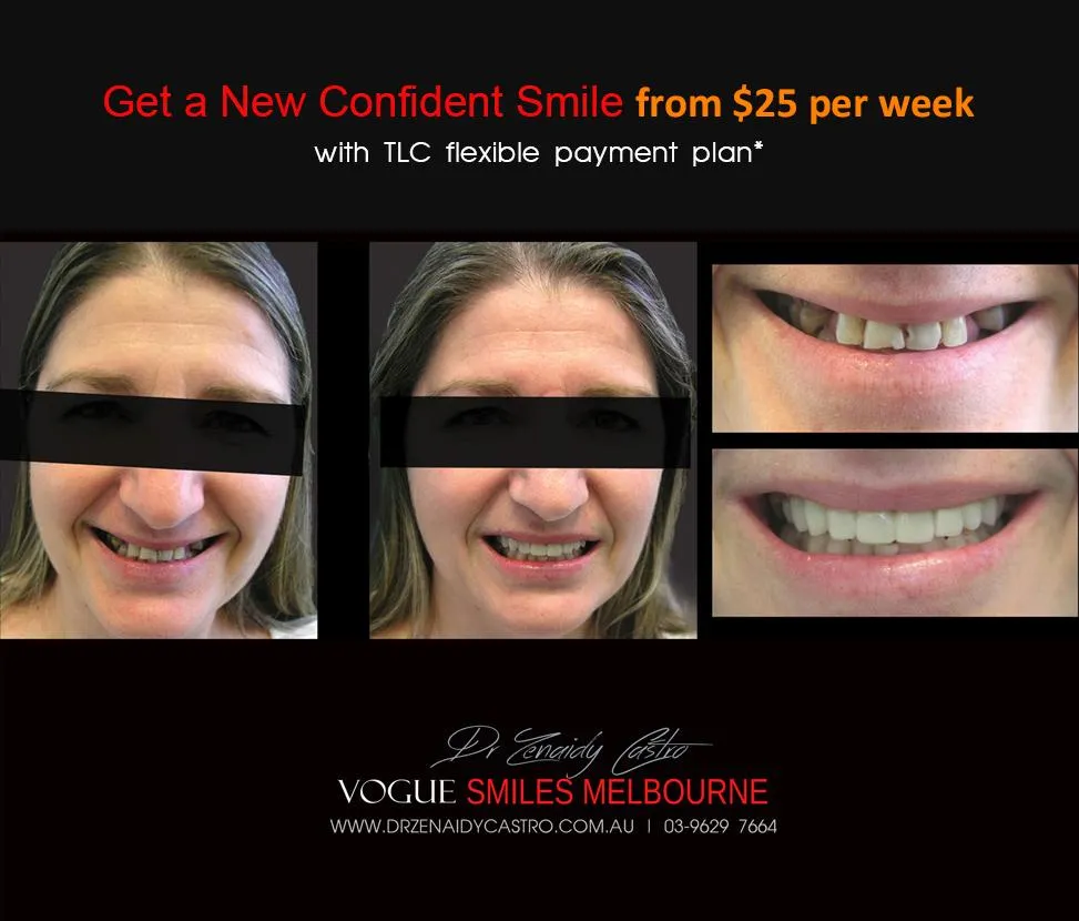 Is there a cheaper option than veneers?- Composite Veneers, Dental Bonding Melbourne CBD and Noble Park North