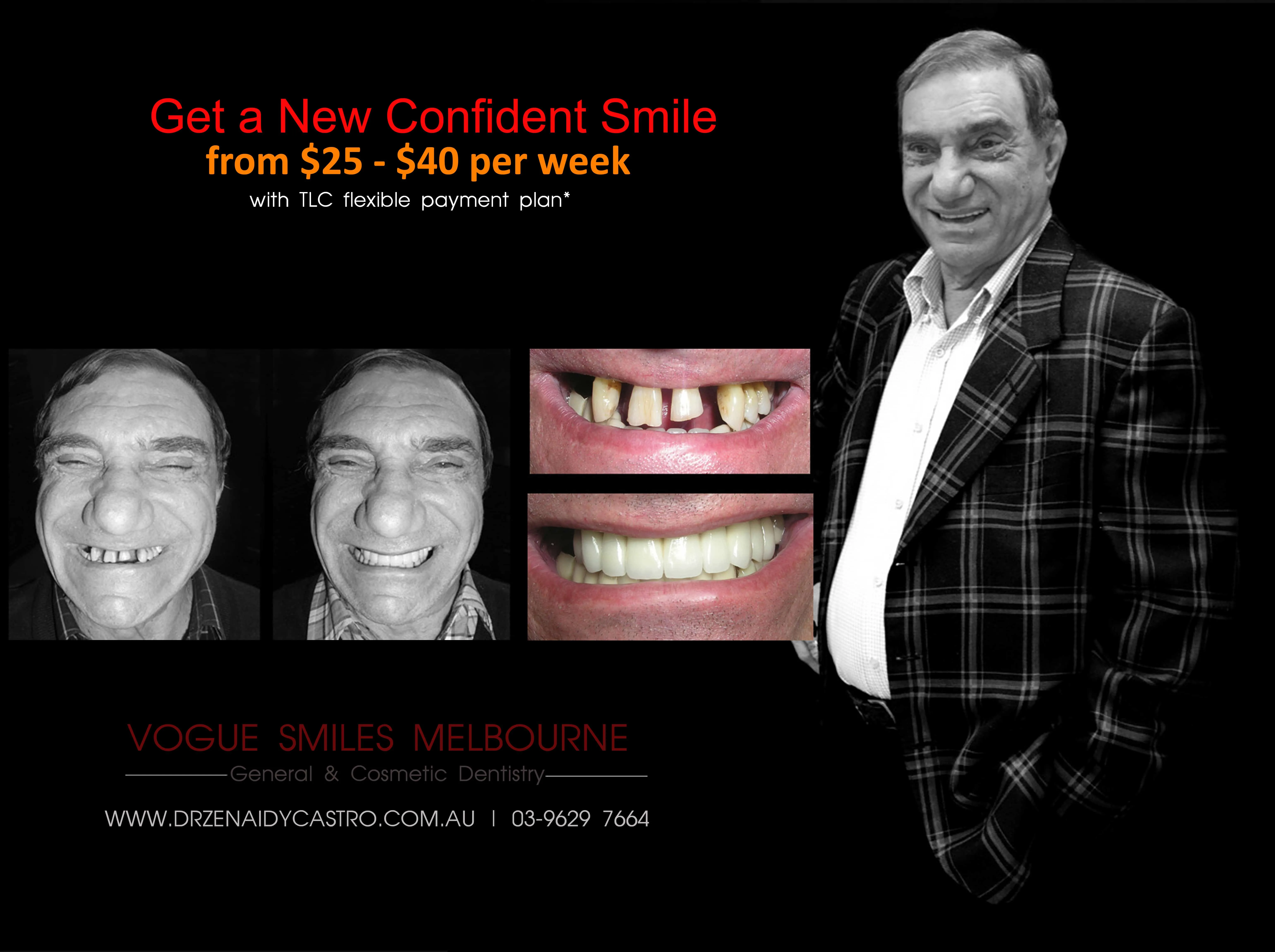 Gappy Teeth Treatment Melbourne with Porcelain Veneers | Veneers for Gappy Smile treatment Cosmetic Dentist Melbourne CBD