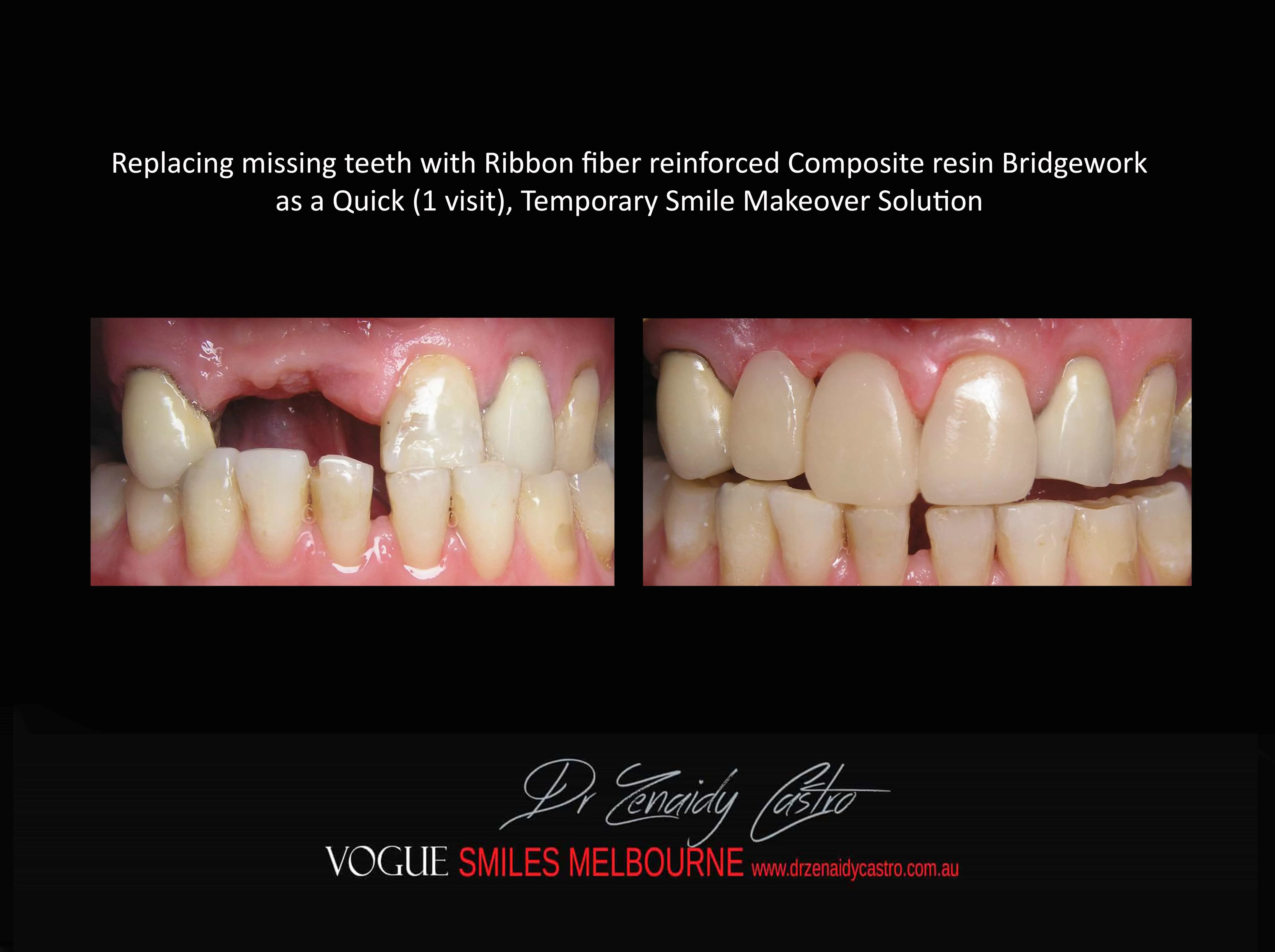 TRANSITIONAL SMILE MAKEOVER Melbourne CBD, Intermediate Cheapest most affordable Cosmetic Dentistry option to improve smile Melbourne Victoria Australia - Cosmetic Dentist Melbourne