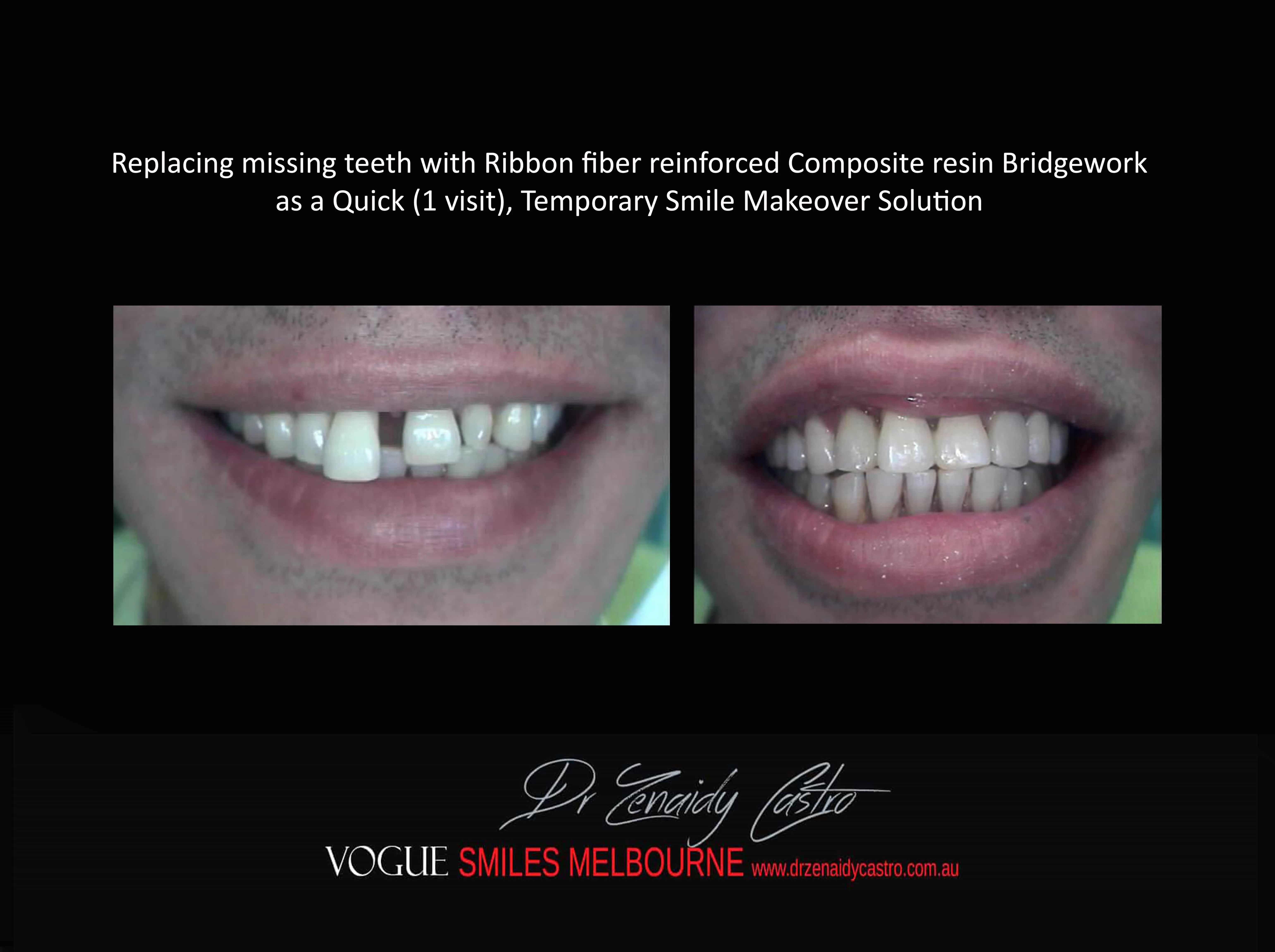 TRANSITIONAL SMILE MAKEOVER Melbourne CBD, Intermediate Cheapest most affordable Cosmetic Dentistry option to improve smile Melbourne Victoria Australia - Cosmetic Dentist Melbourne