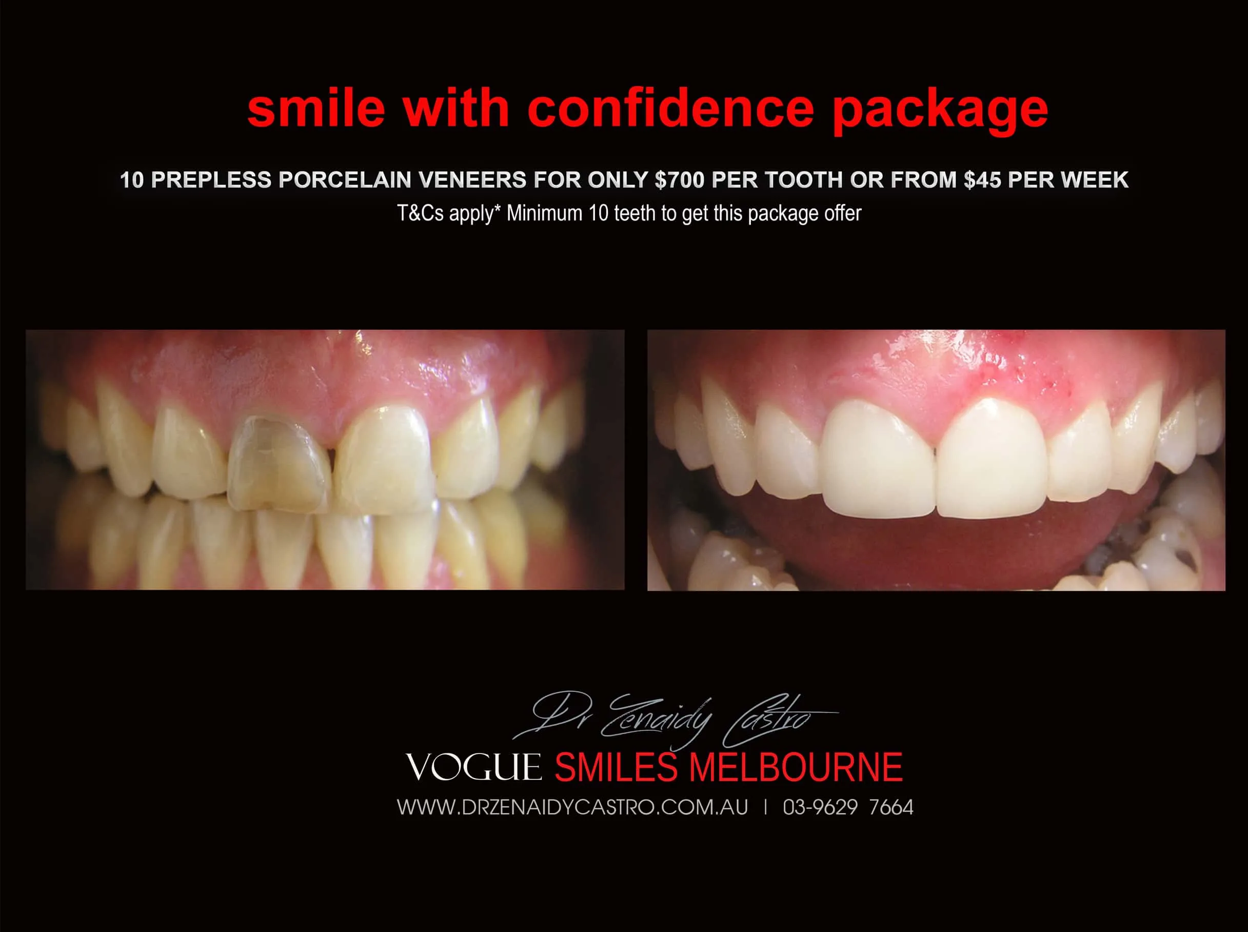 Black Tooth treatment- Dead Front tooth Treatment With Porcelain Veneers Melbourne CBD Cosmetic Dentist