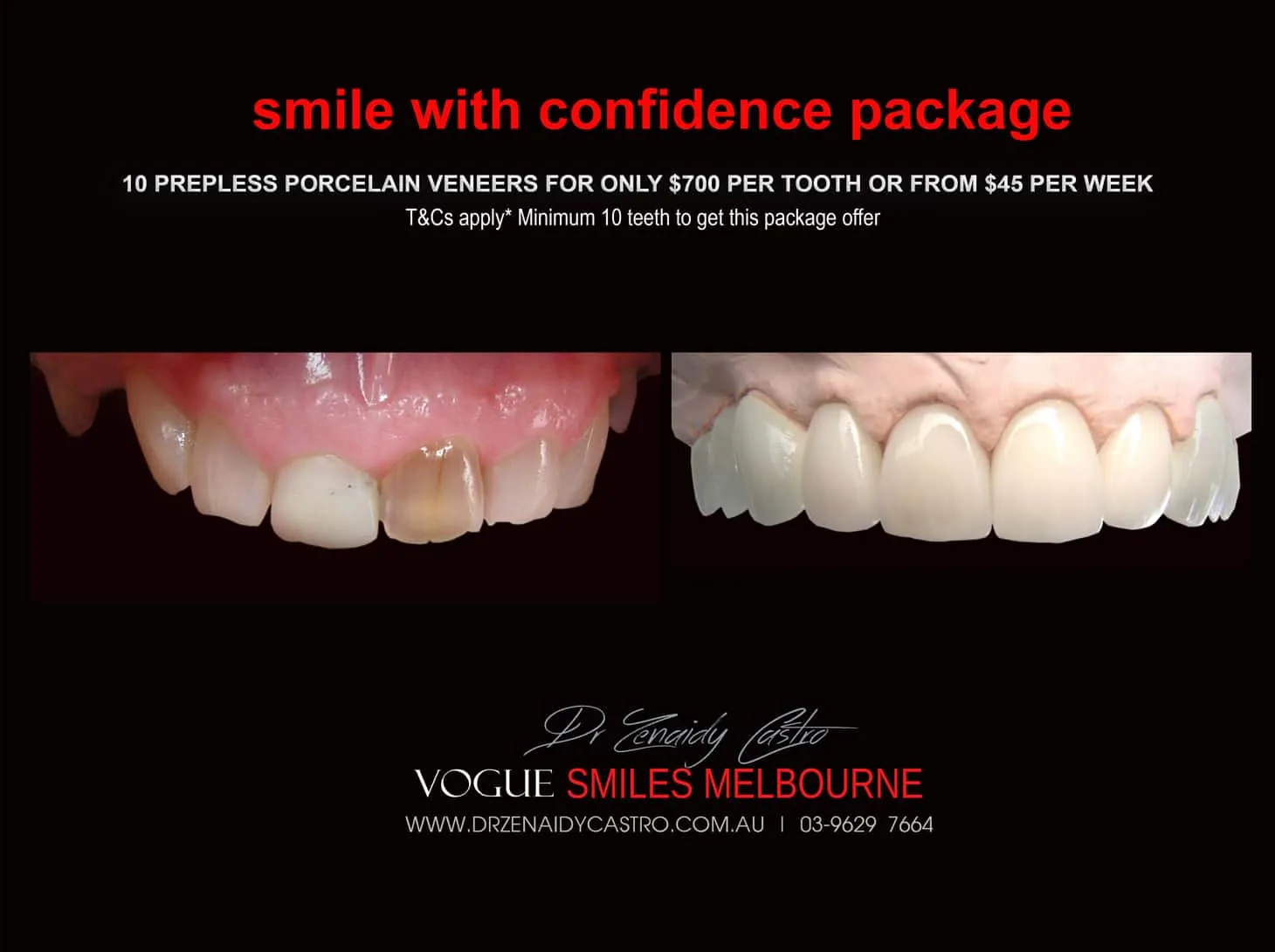 Black Tooth treatment- Dead Front tooth Treatment With Porcelain Veneers Melbourne CBD Cosmetic Dentist