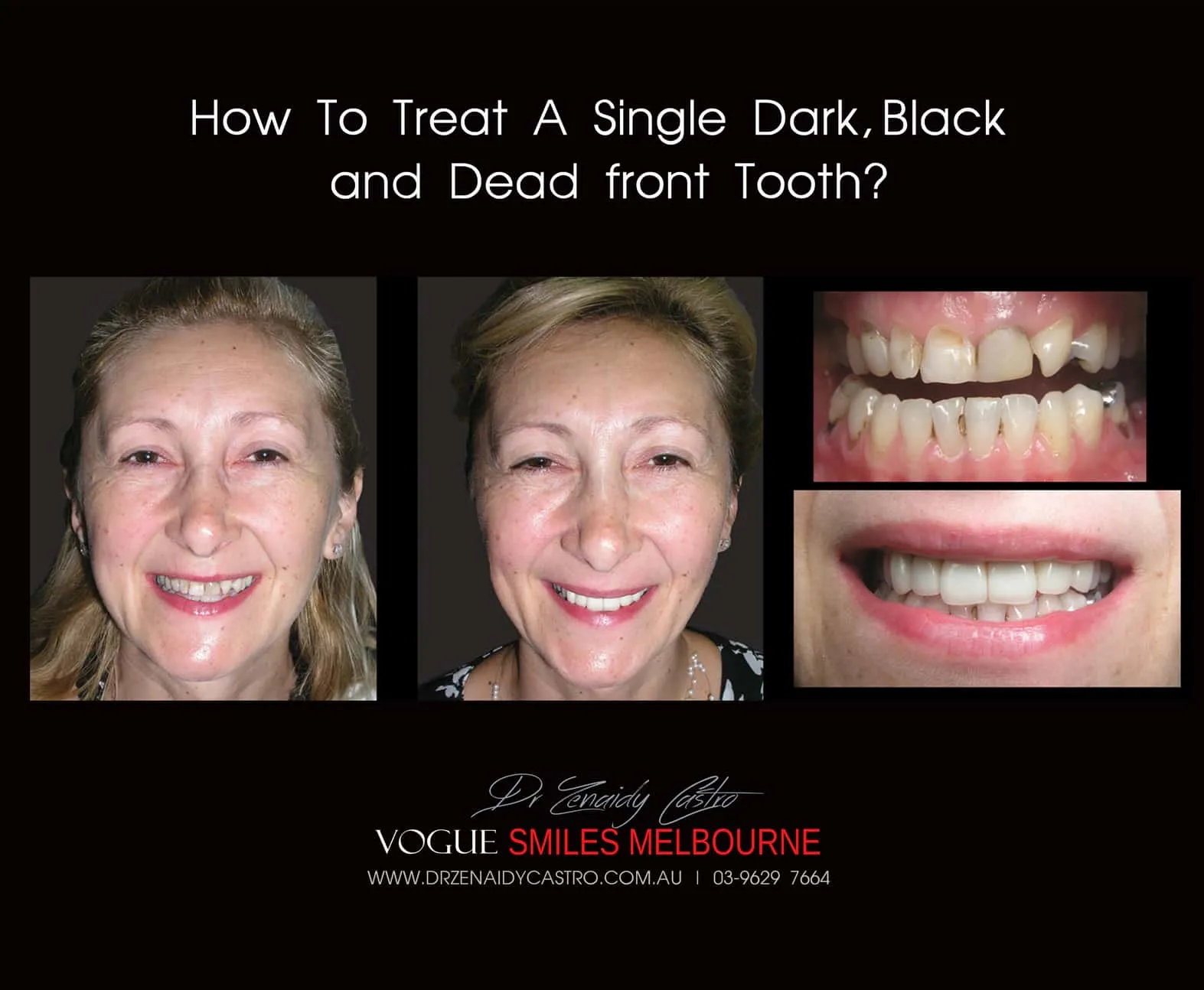 Black Tooth treatment- Dead Front tooth Treatment With Porcelain Veneers Melbourne CBD Cosmetic Dentist