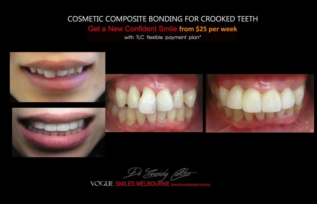 Cosmetic Bonding for Crooked Teeth Melbourne CBD Cosmetic Dentist