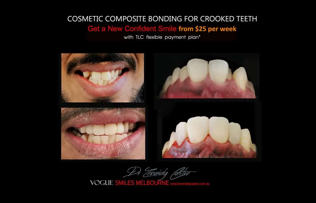 Cosmetic Bonding for Crooked Teeth Melbourne CBD Cosmetic Dentist