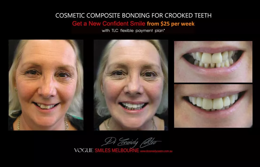 Cosmetic Bonding for Crooked Teeth Melbourne CBD Cosmetic Dentist