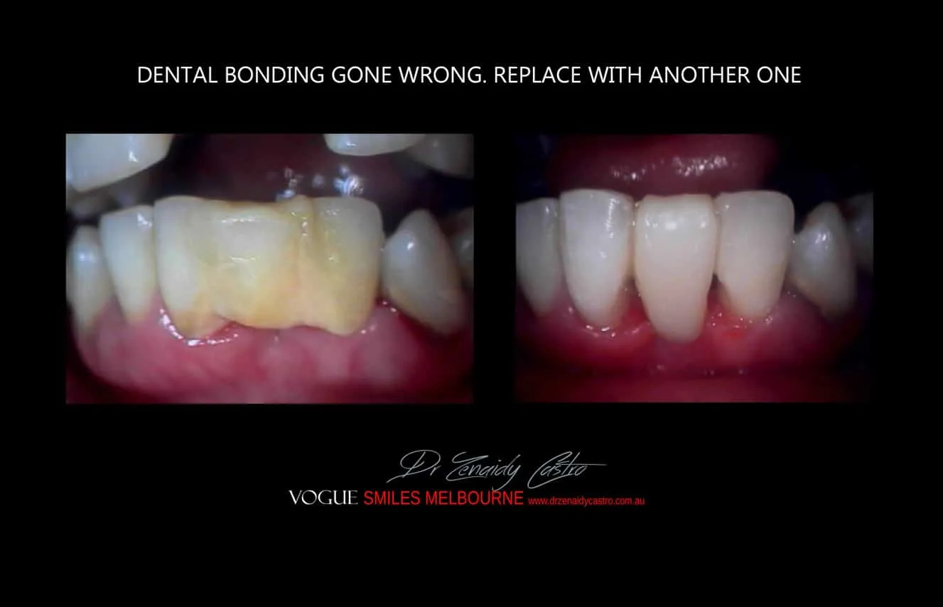 Is there a cheaper option than veneers?- Composite Veneers, Dental Bonding Melbourne CBD and Noble Park North