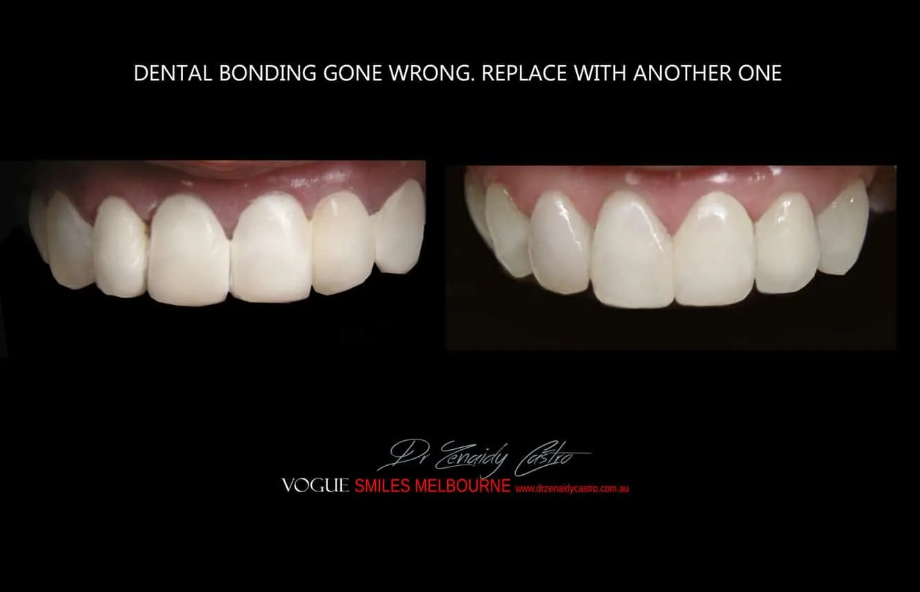 Is there a cheaper option than veneers?- Composite Veneers, Dental Bonding Melbourne CBD and Noble Park North