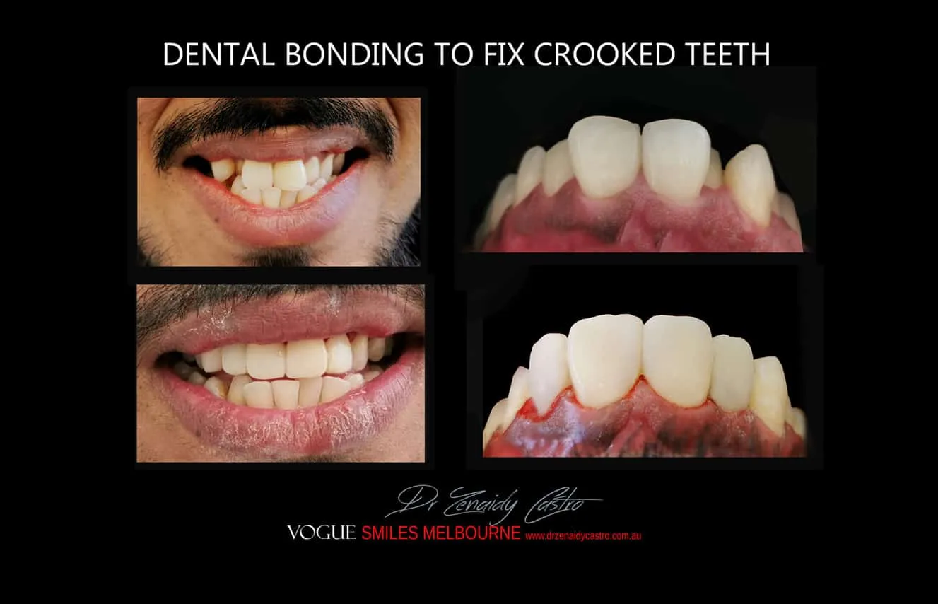 Is there a cheaper option than veneers?- Composite Veneers, Dental Bonding Melbourne CBD and Noble Park North