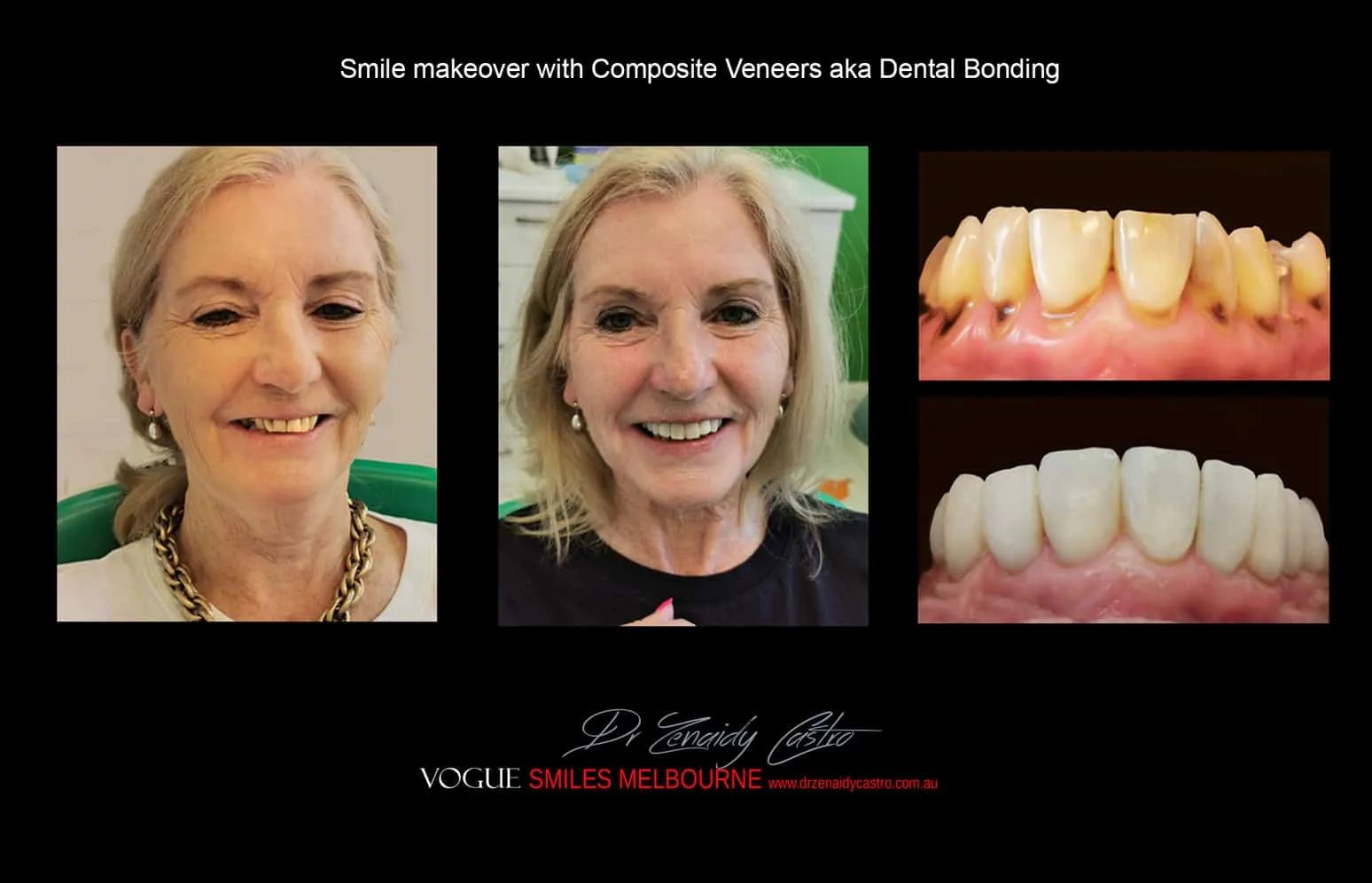 Is there a cheaper option than veneers?- Composite Veneers, Dental Bonding Melbourne CBD and Noble Park North